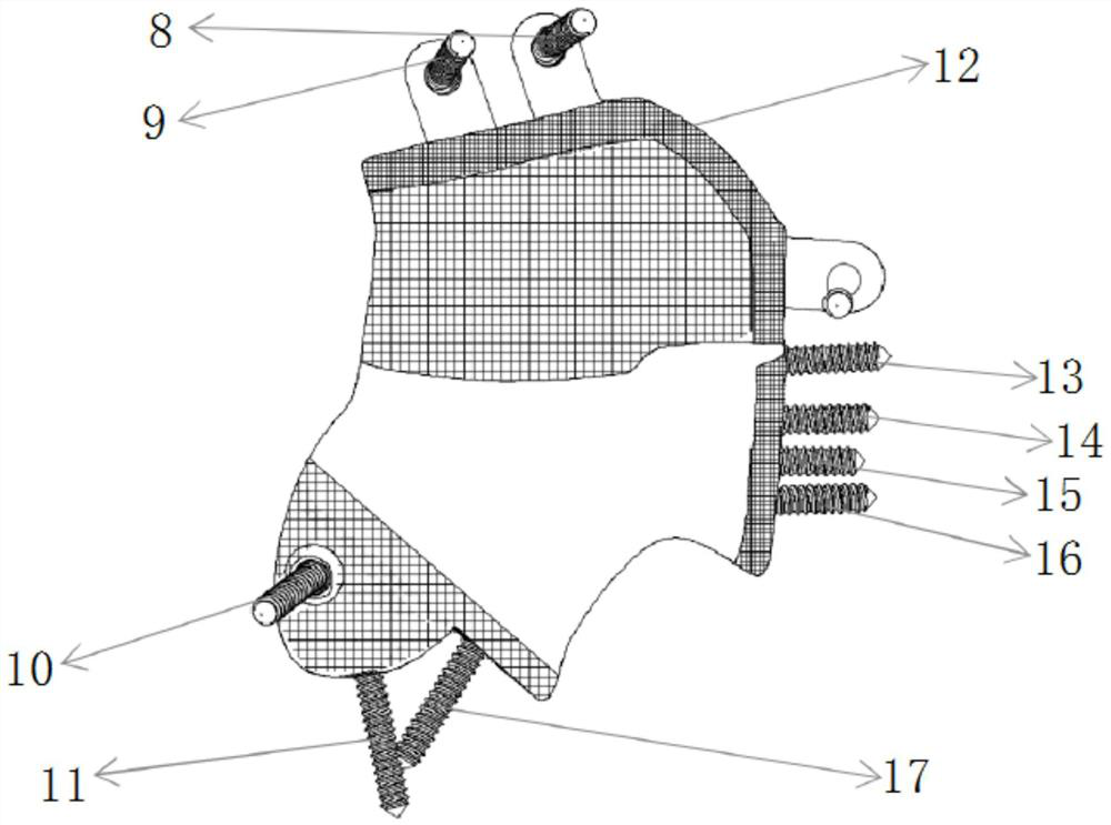 Individualized pelvic prosthesis