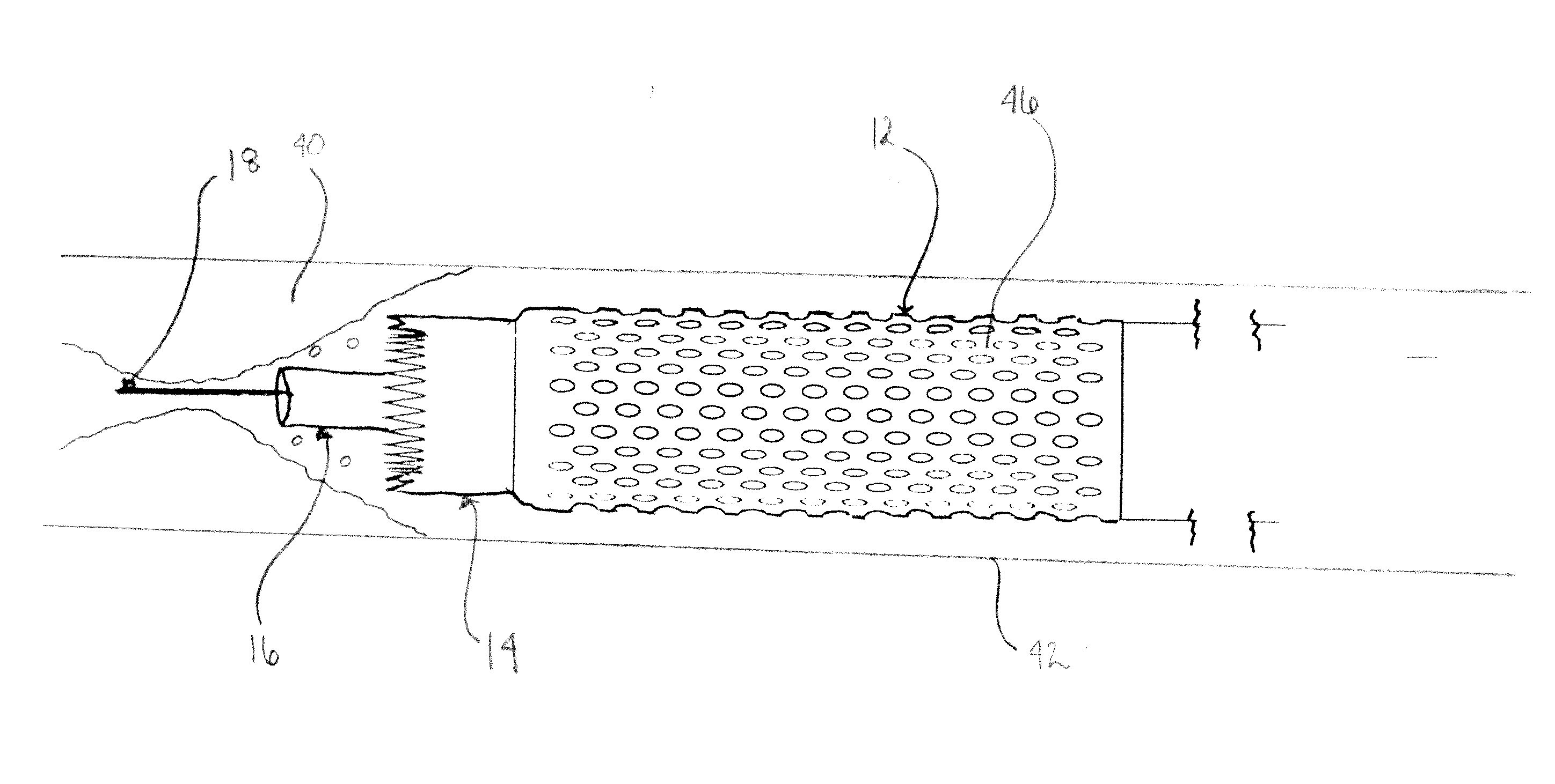 Catheter for Use in Revascularization Procedures and Method of Using Same