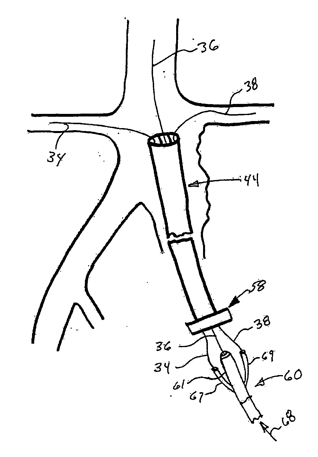 Conduit for interventional procedures