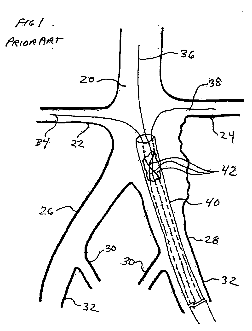 Conduit for interventional procedures