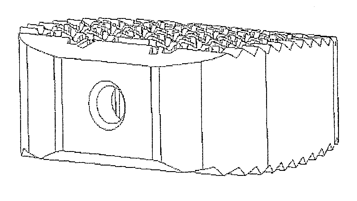 Intervertebral implant