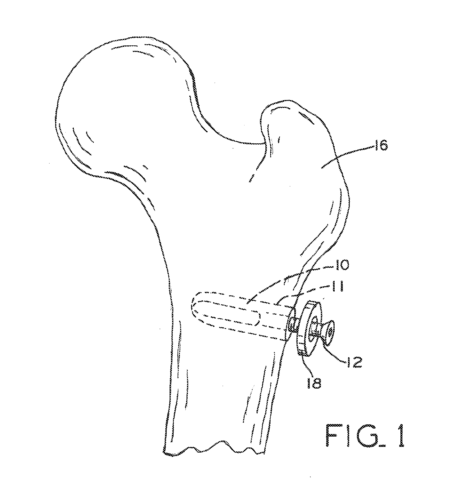 Screw thread placement in a porous medical device
