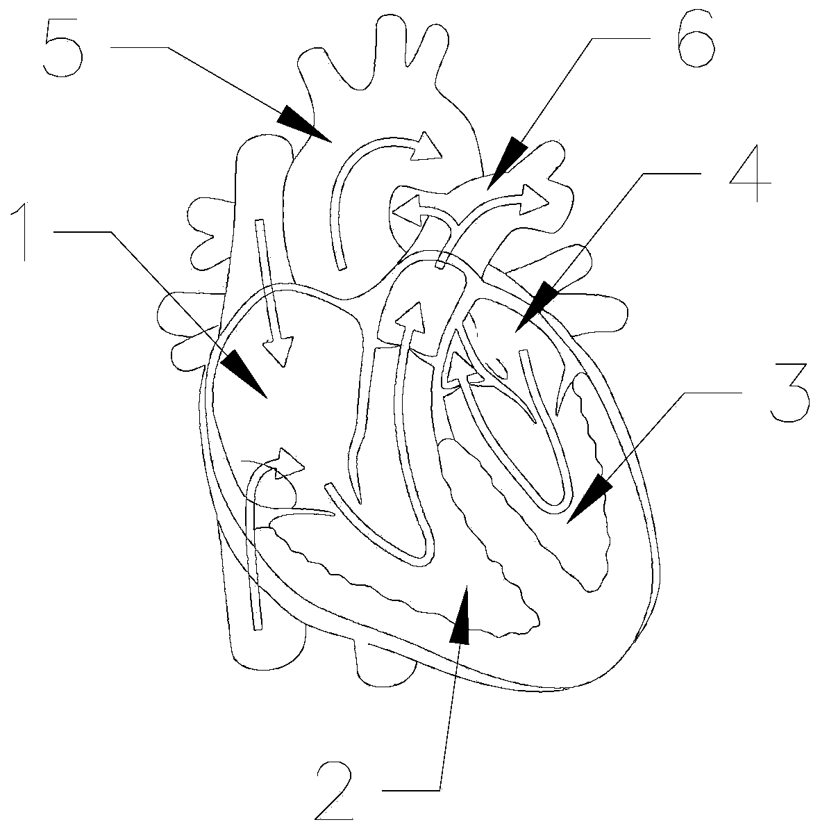 Catheter for myocardial protection liquid perfusion through percutaneous intervention