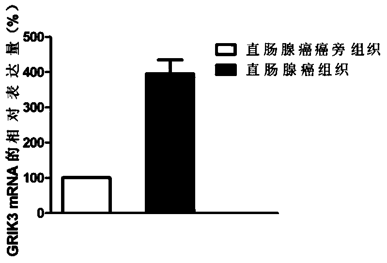 Molecular marker GRIK3 in rectal adenocarcinoma