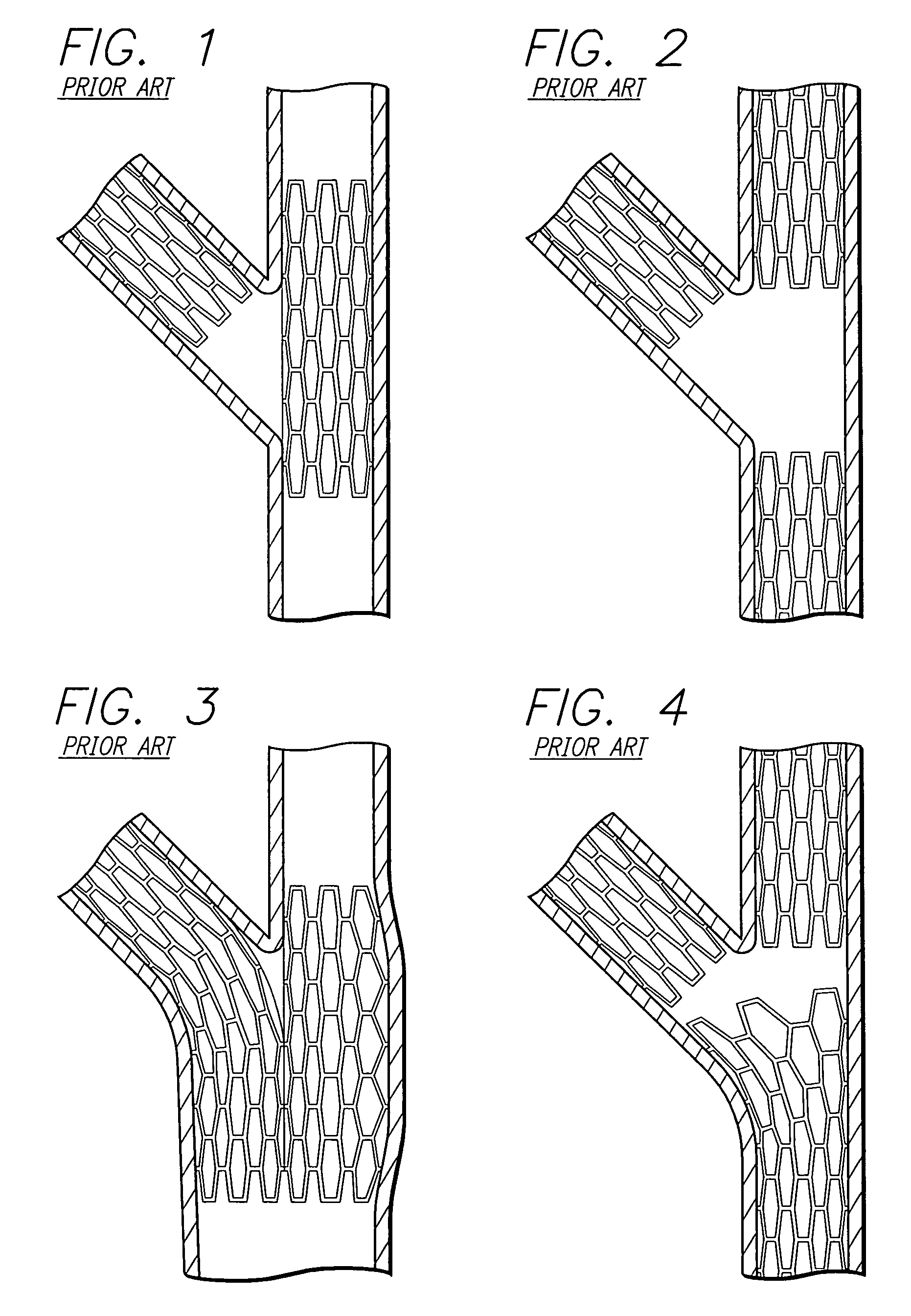 Catheter assembly and method for treating bifurcations