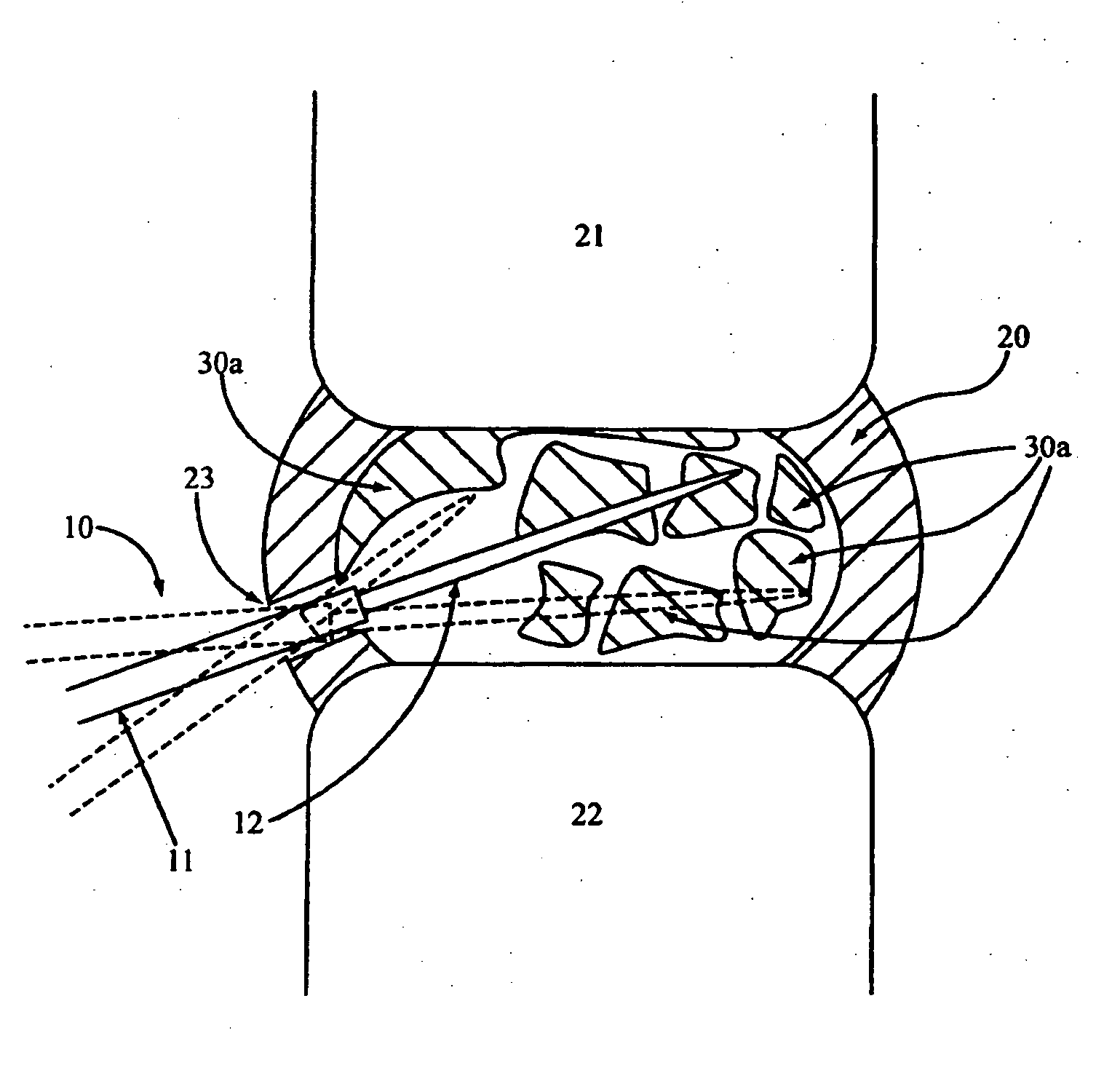 Methods for explantation of intervertebral disc implants