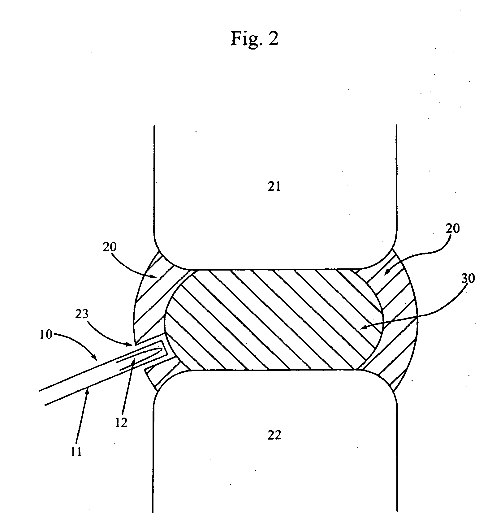 Methods for explantation of intervertebral disc implants