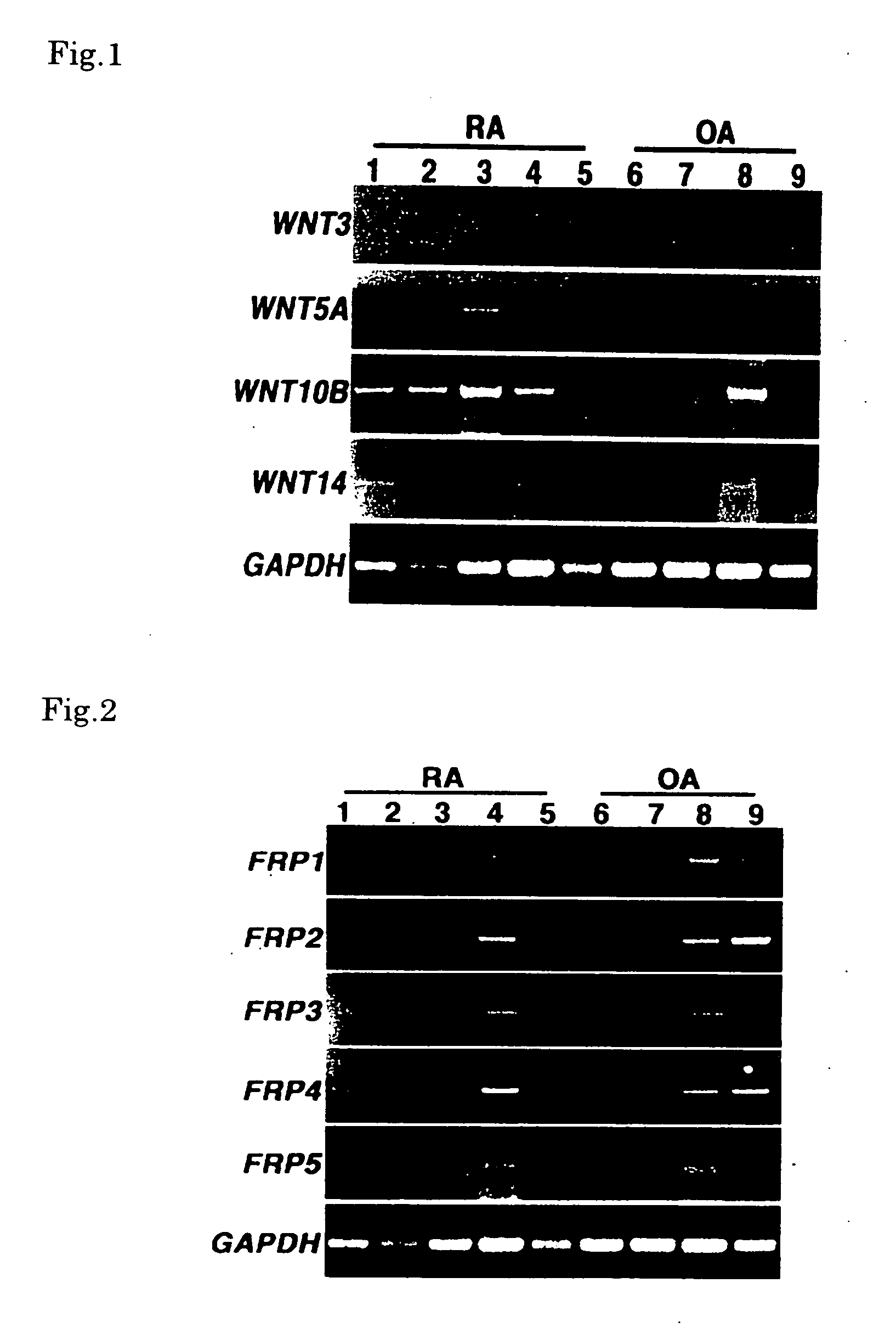 Method of detecting rheumatoid arthritis by detecting overexpression of wnt