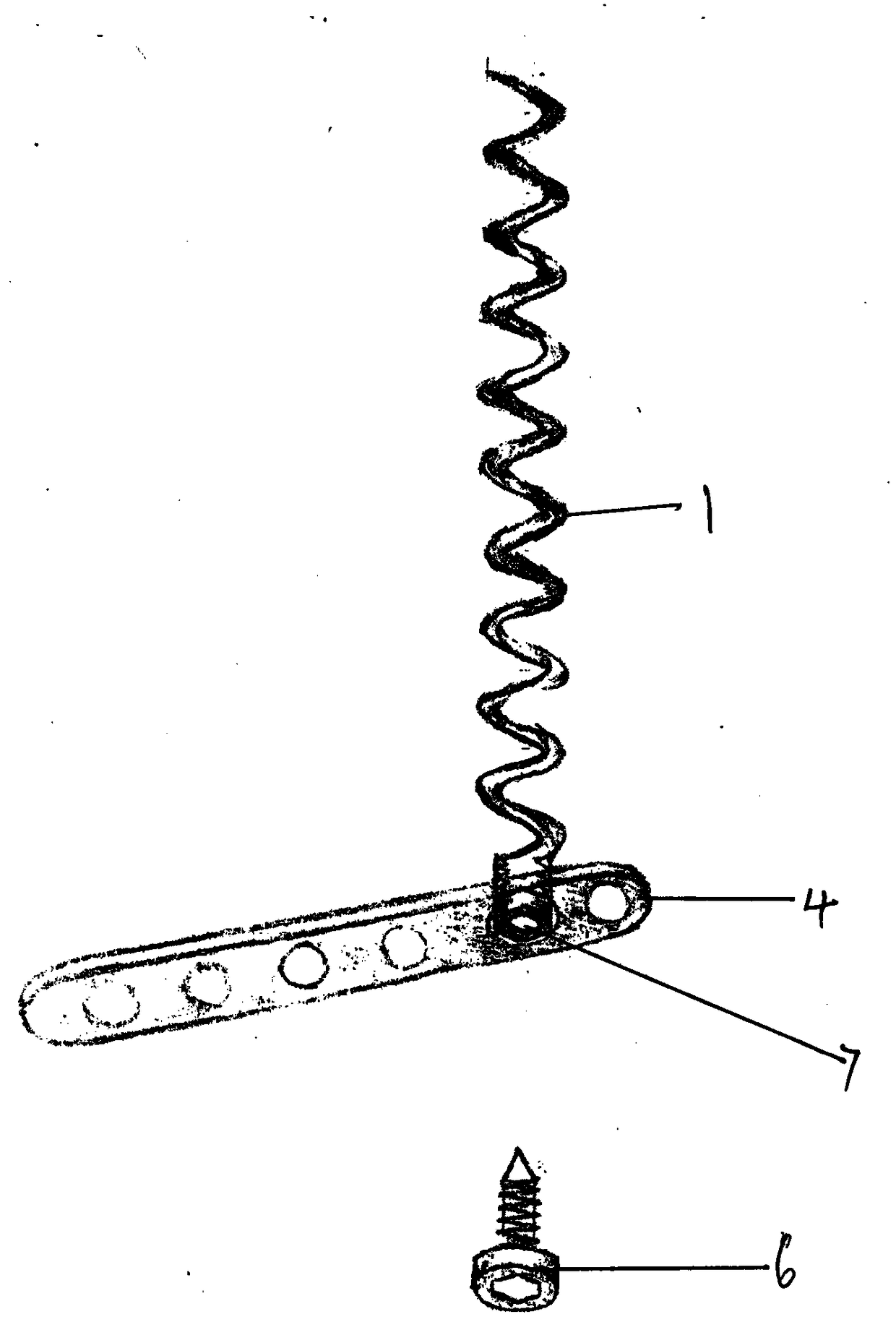 Screw nail for fixing fractured cancellous bone