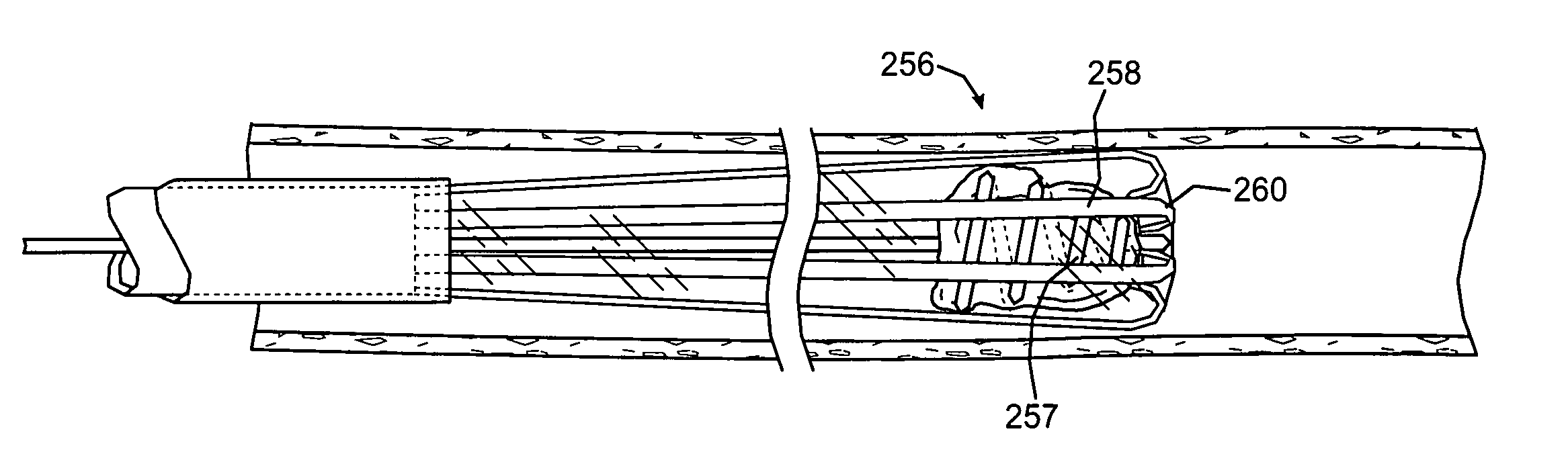 Systems, methods and devices for removing obstructions from a blood vessel