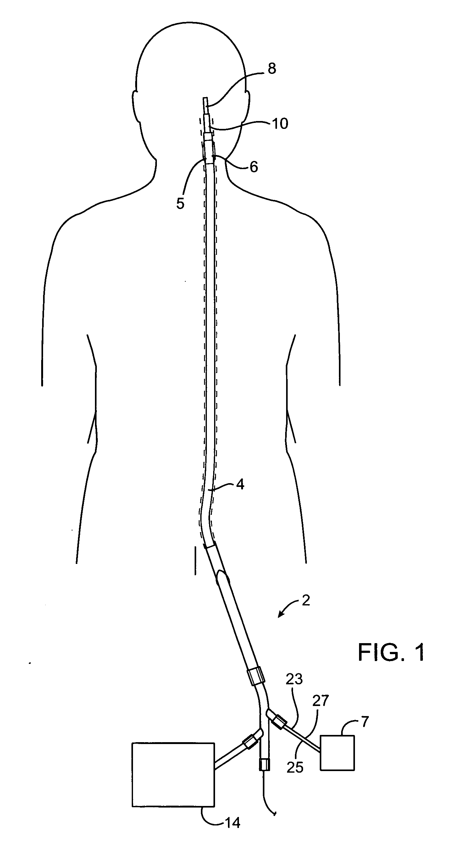 Systems, methods and devices for removing obstructions from a blood vessel