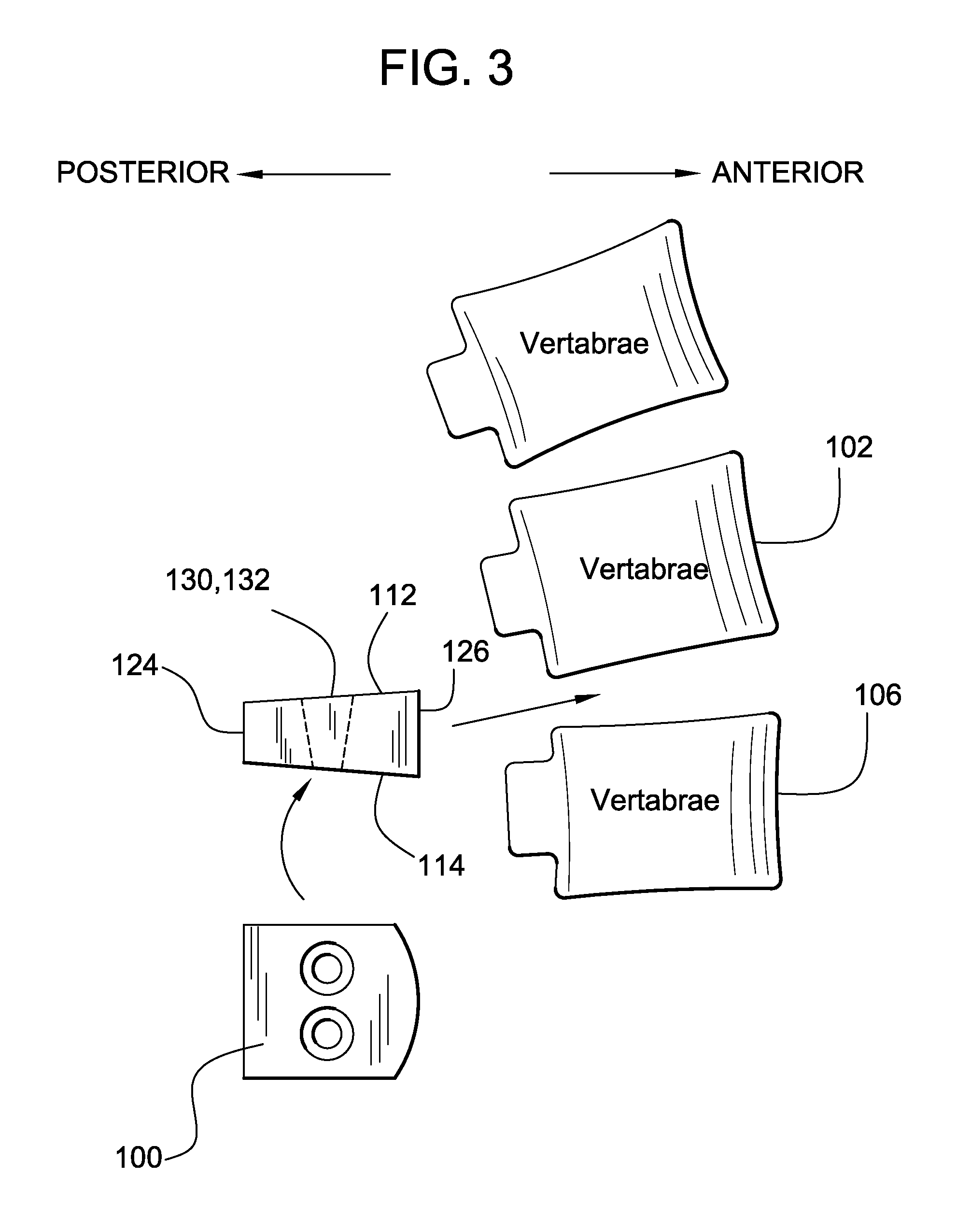 Intervertebral Spinal Implant and Method of Making the Same