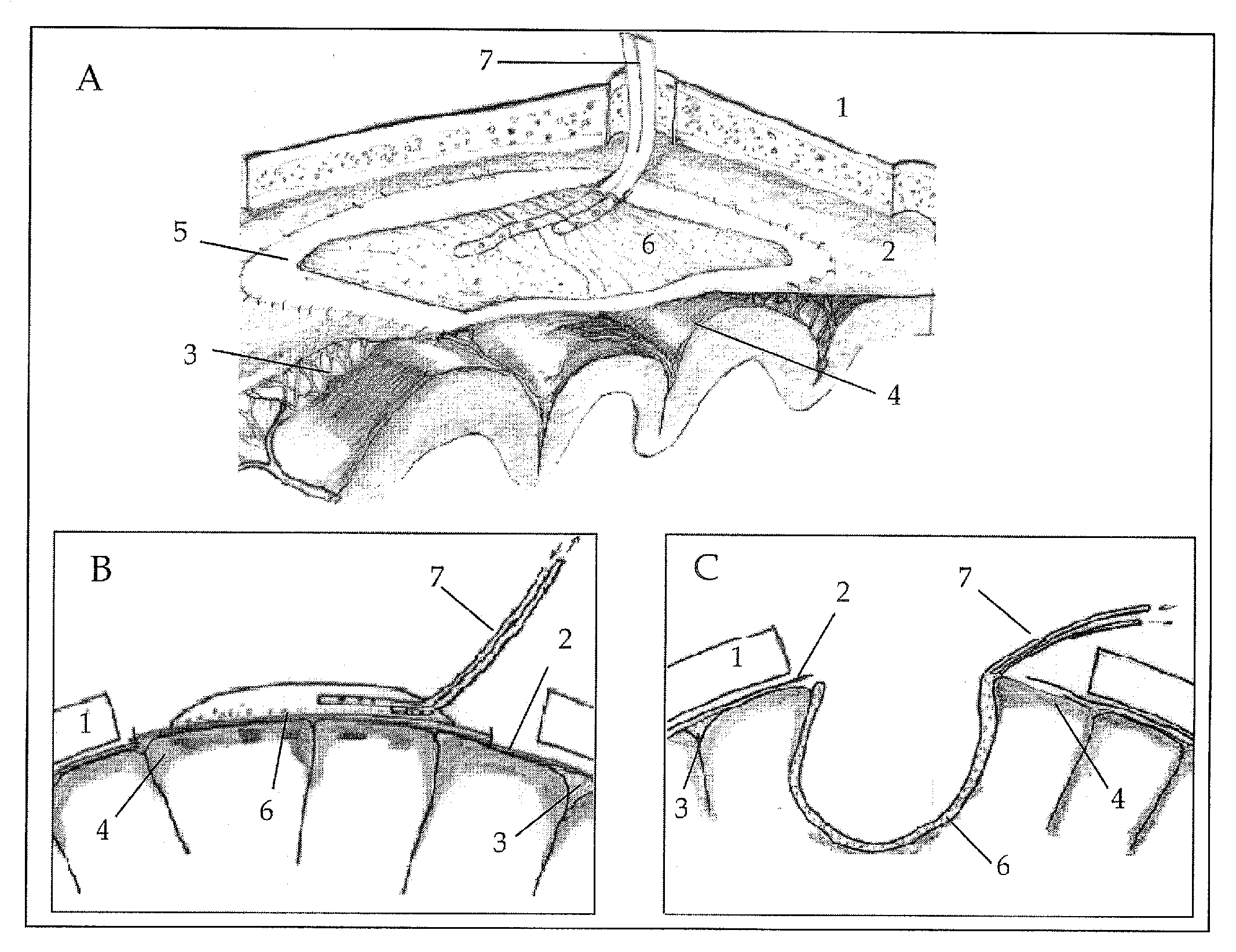 Device to reduce brain edema by surface dialysis and cooling