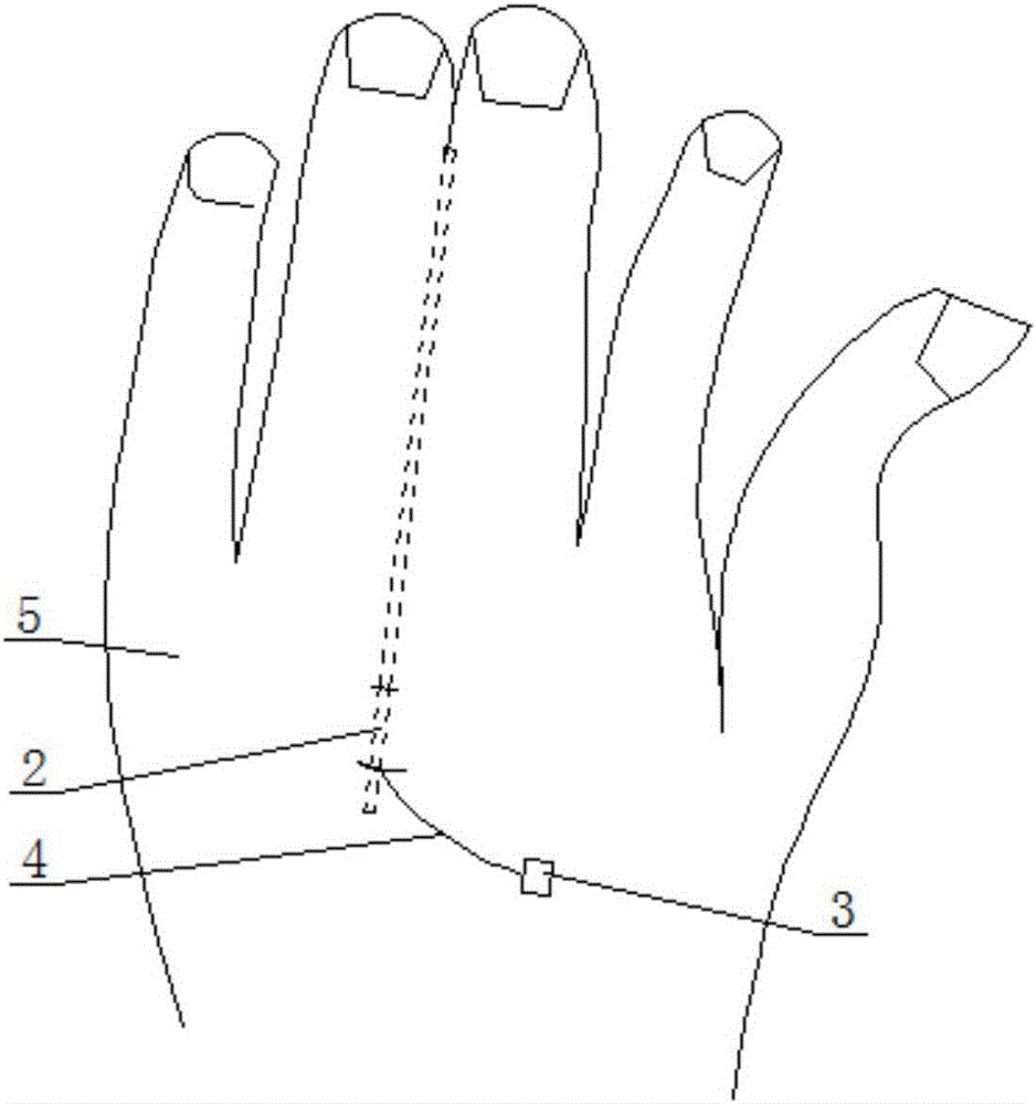 Syndactylia skin expander