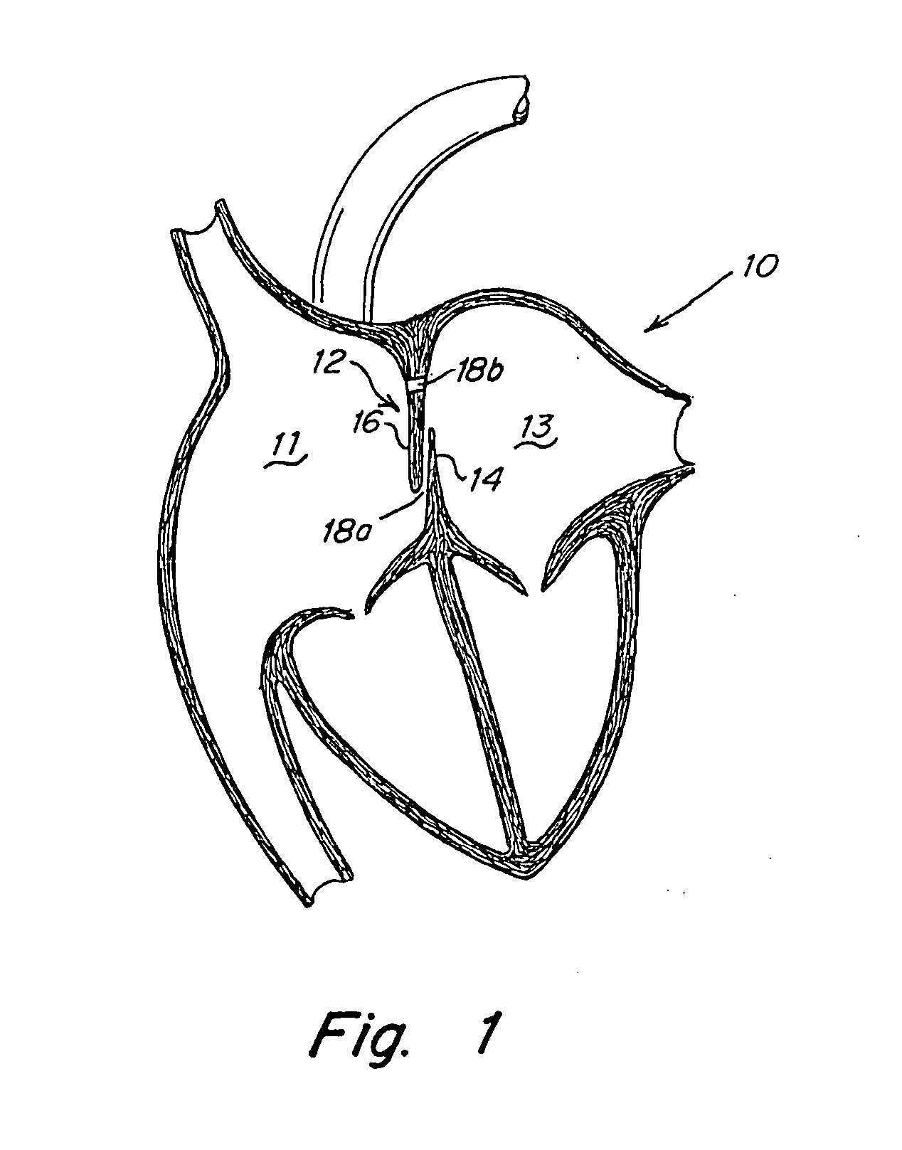 Radiopaque bioabsorbable occluder