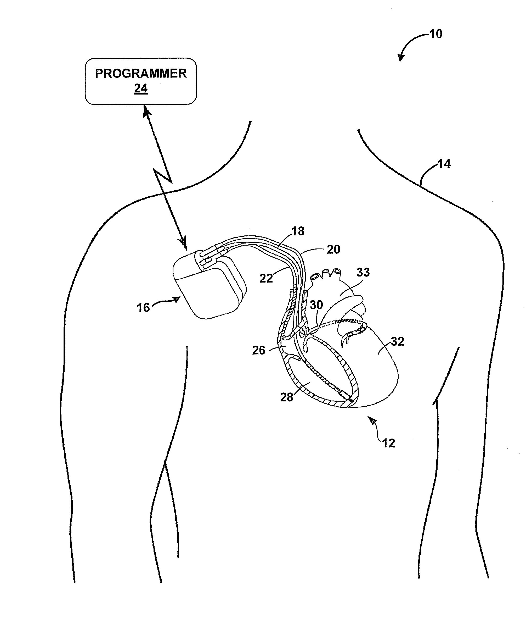 Automatic adjustment of arrhythmia detection parameters