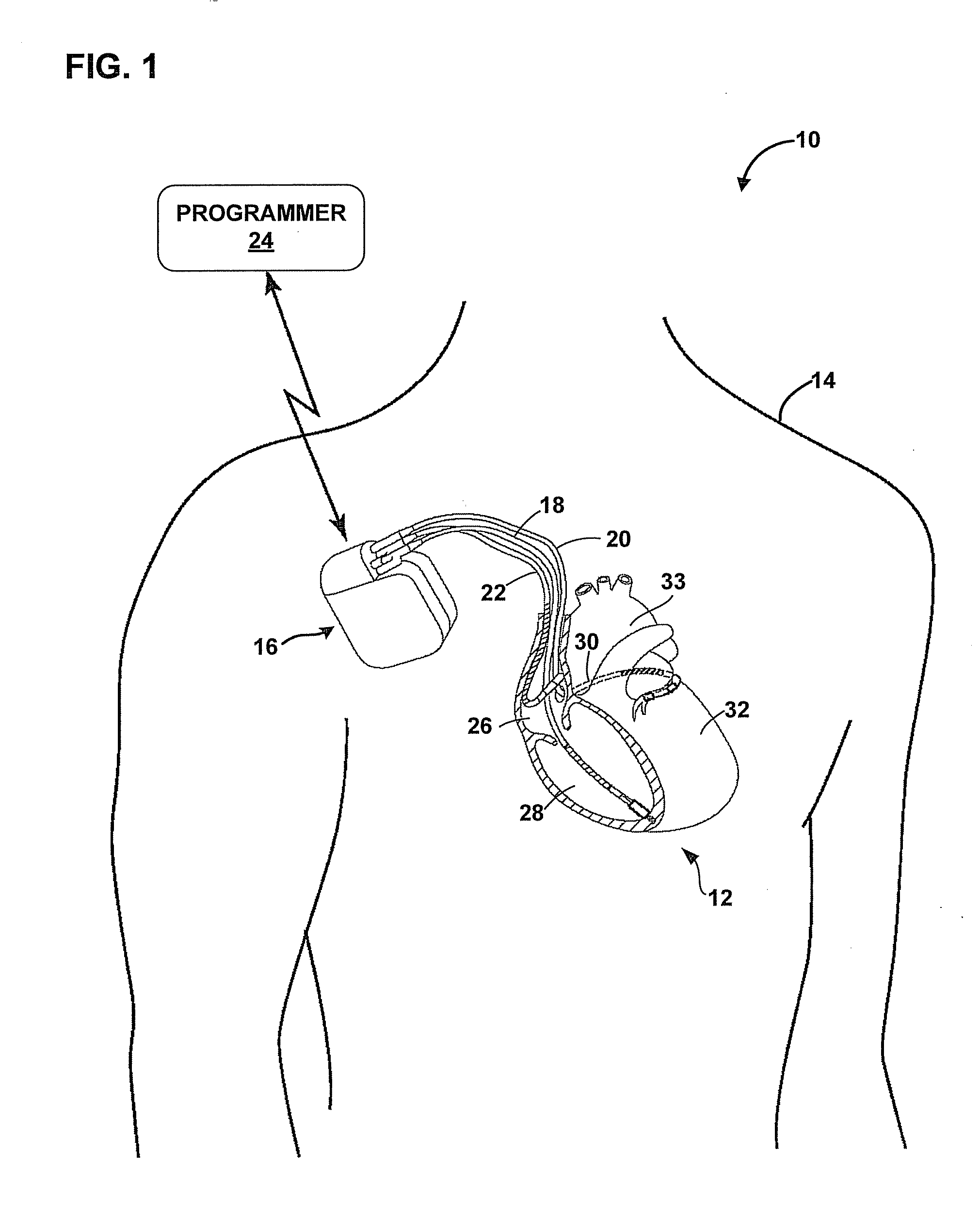 Automatic adjustment of arrhythmia detection parameters