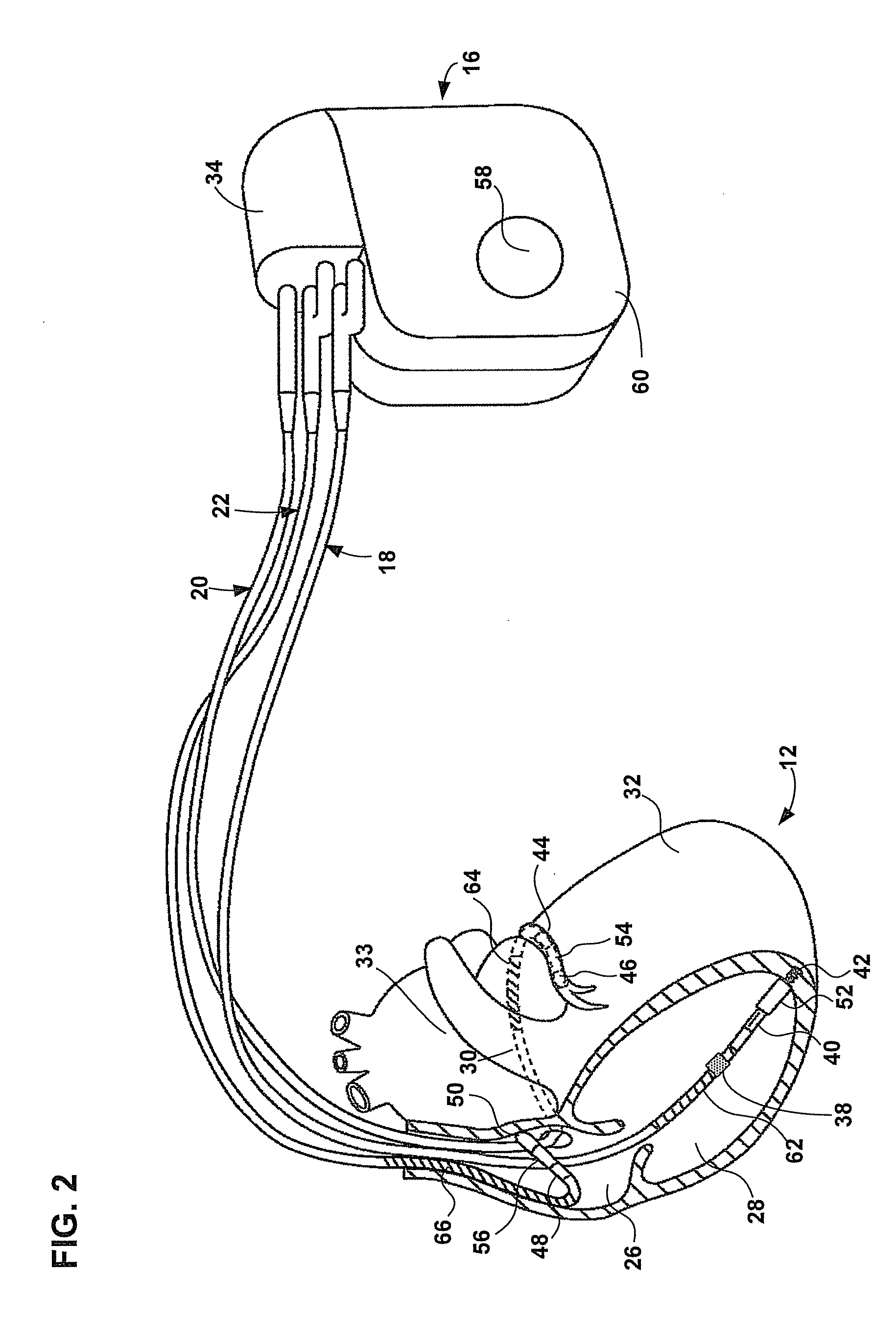 Automatic adjustment of arrhythmia detection parameters