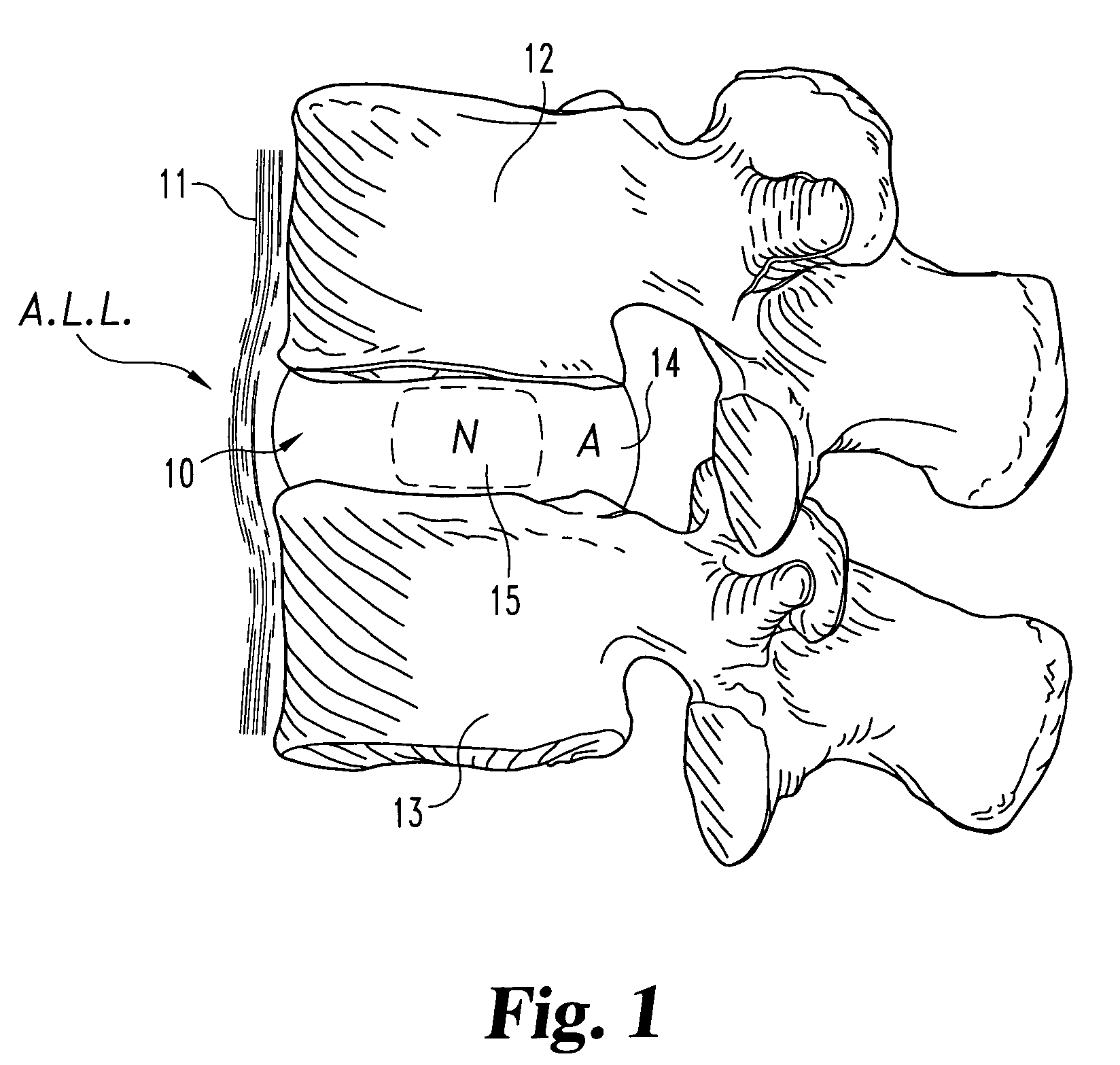 Allogenic/xenogenic implants and methods for augmenting or repairing intervertebral discs