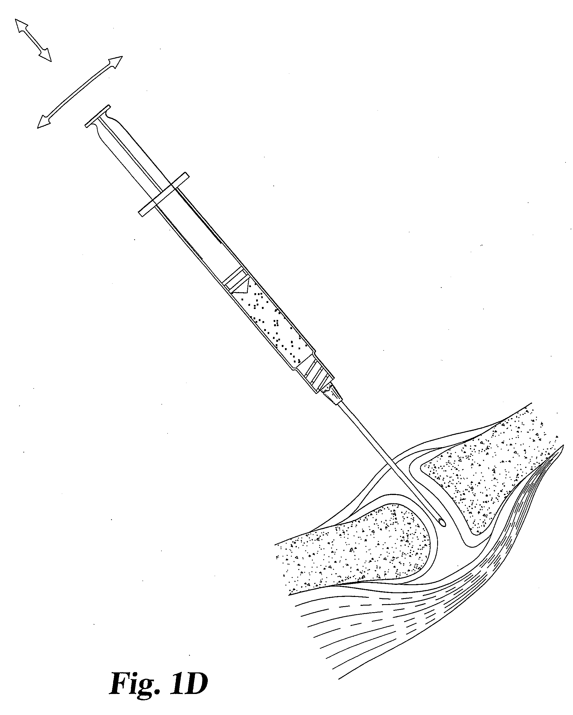 Collagen-based materials and methods for treating synovial joints