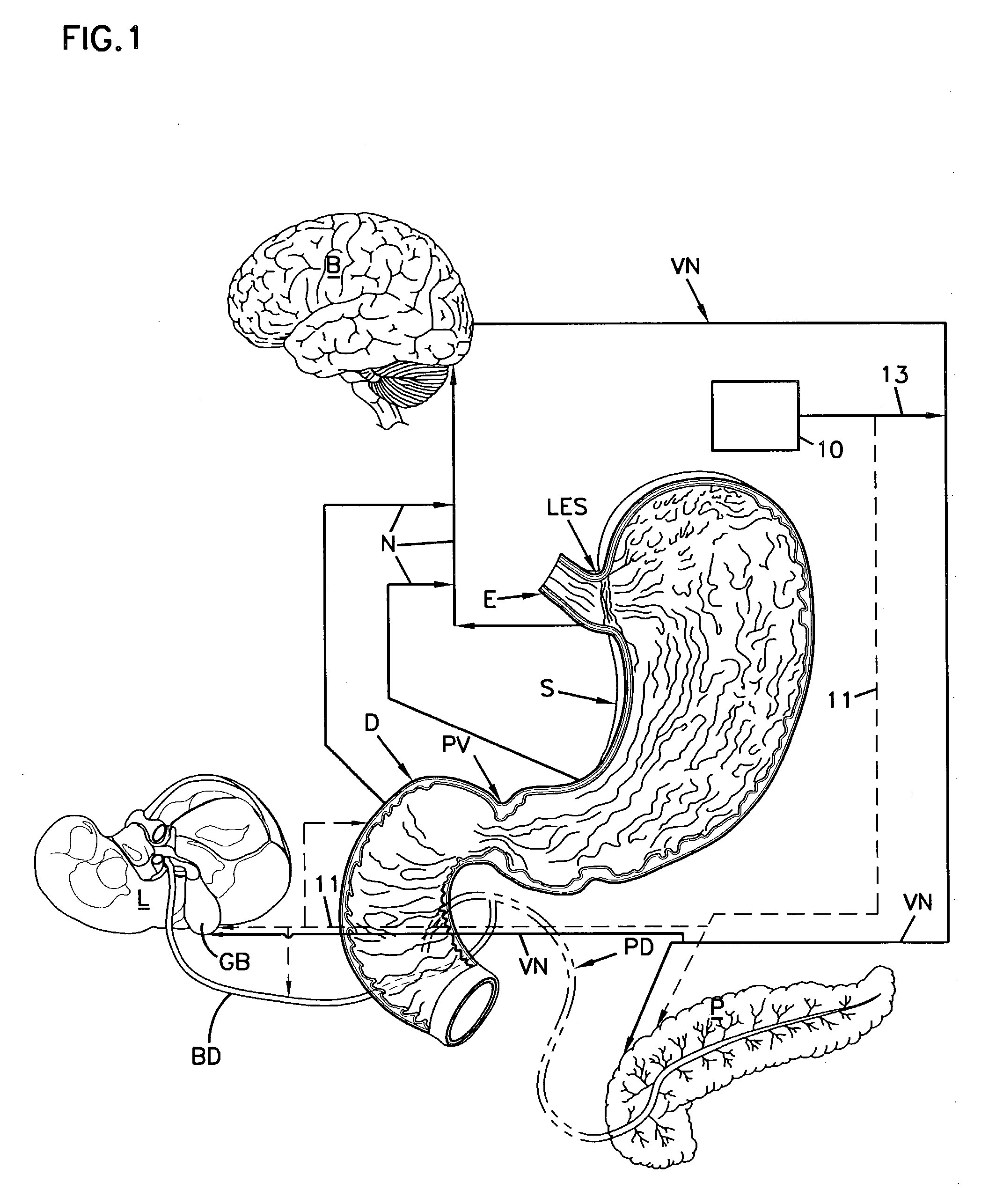 Method and apparatus for treatment of gastro-esophageal reflux disease (GERD)