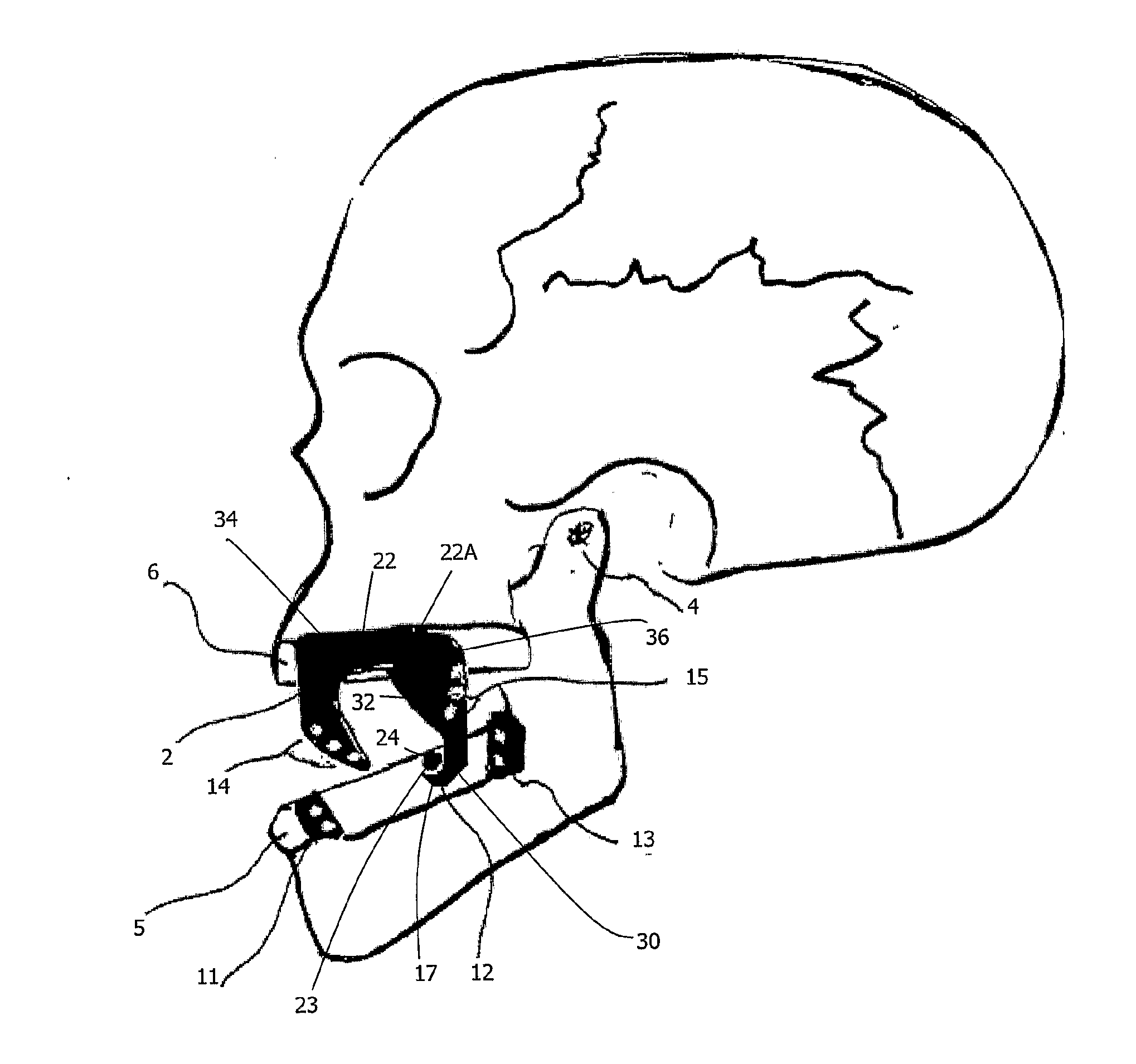 Mandibular Advancement Device