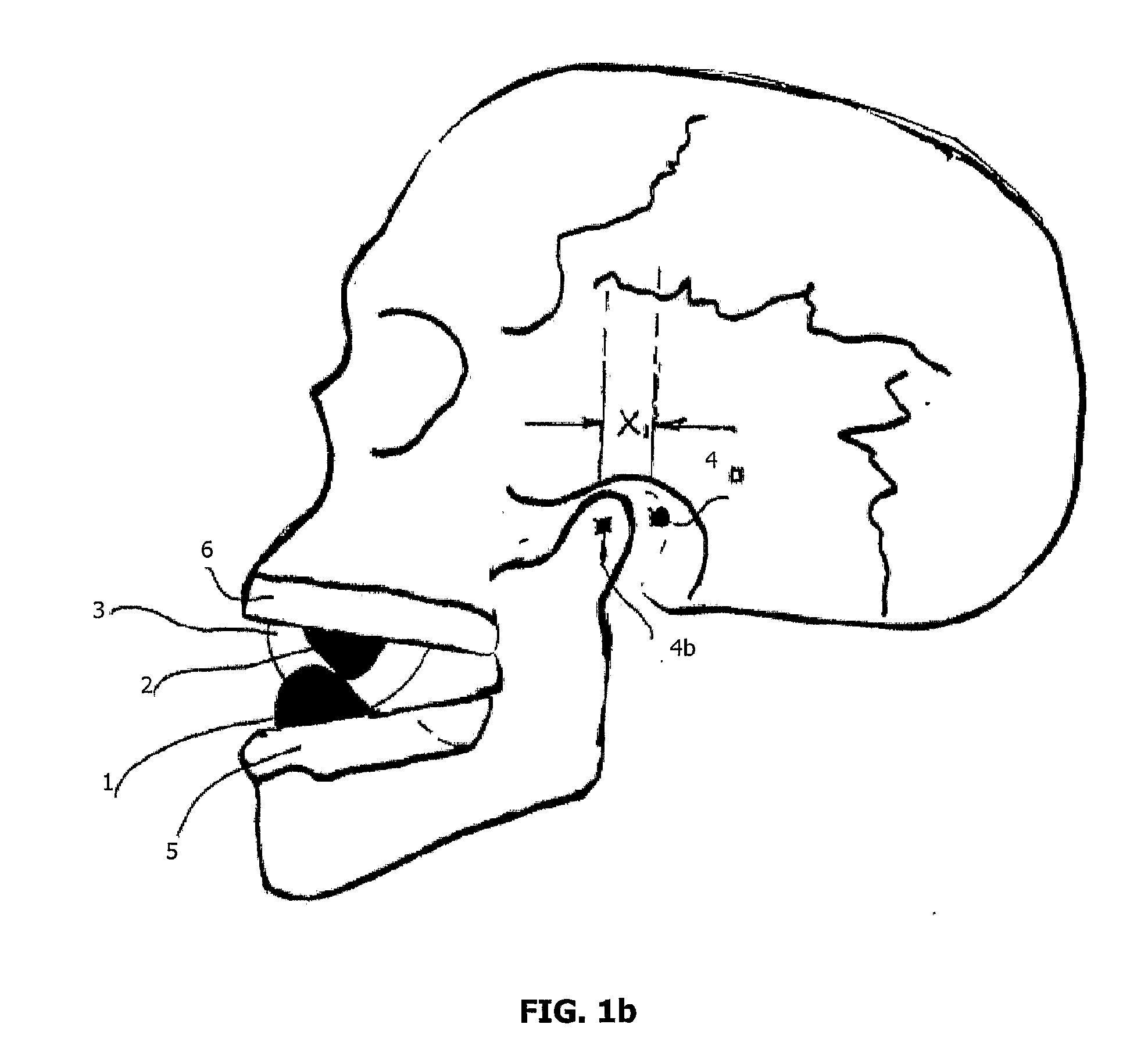 Mandibular Advancement Device