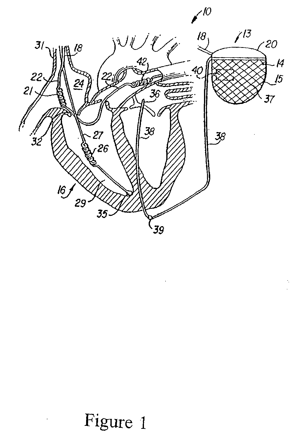 Automated Assessment Of Atrioventricular And Ventriculoatrial Conduction