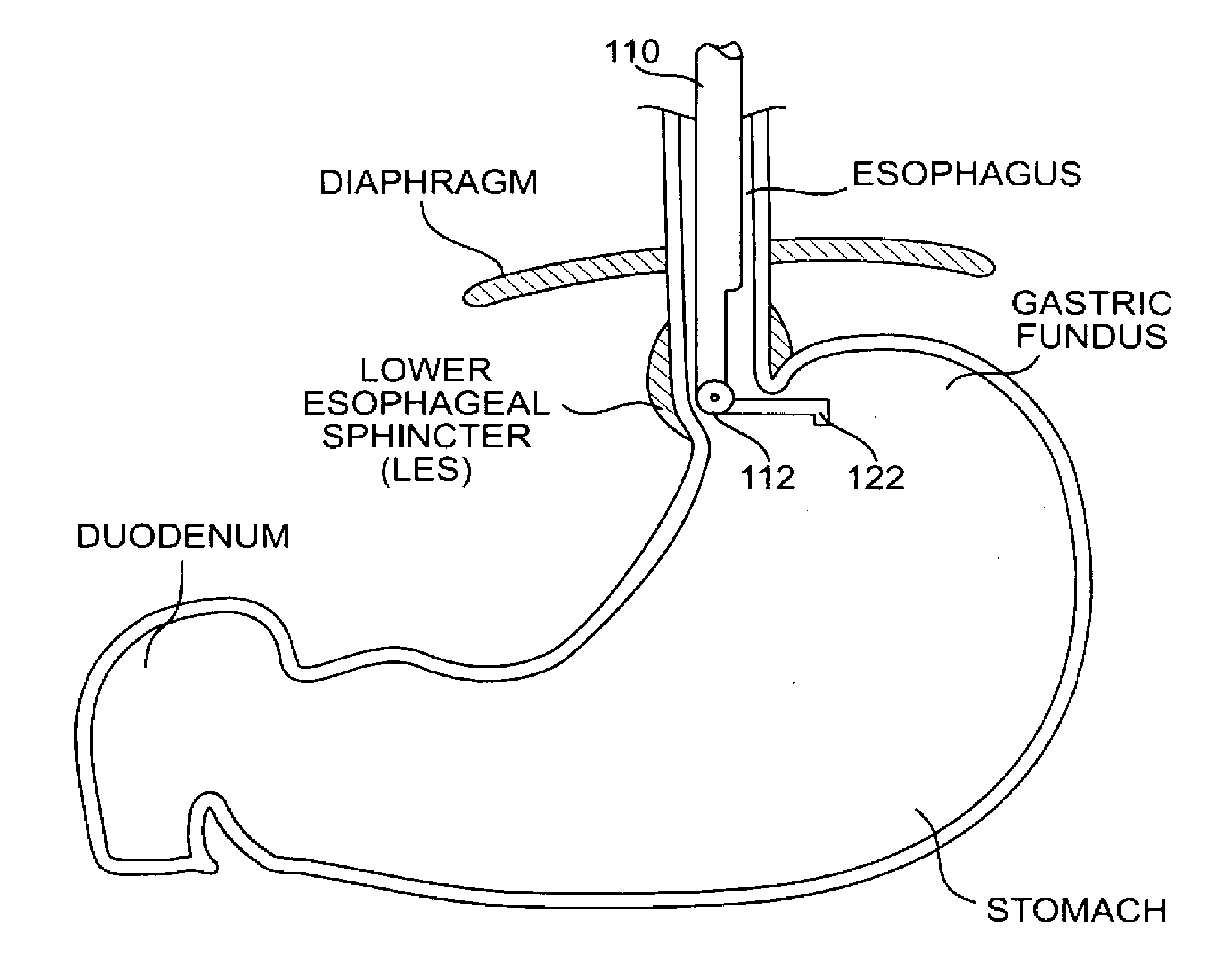 Methods and devices for folding and securing tissue