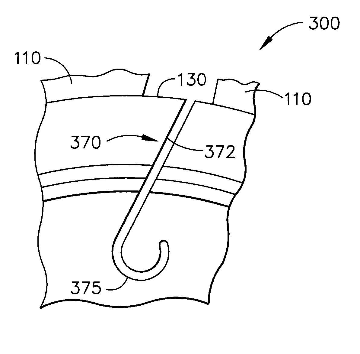 Hoop stress relief mechanism for gas turbine engines