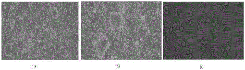 Method for preparing anti-tumor combined immune cells DC (dendritic cell)-CIKs (cytokine induced killers) and NKs (natural killers) simultaneously and prepared combined immune cells