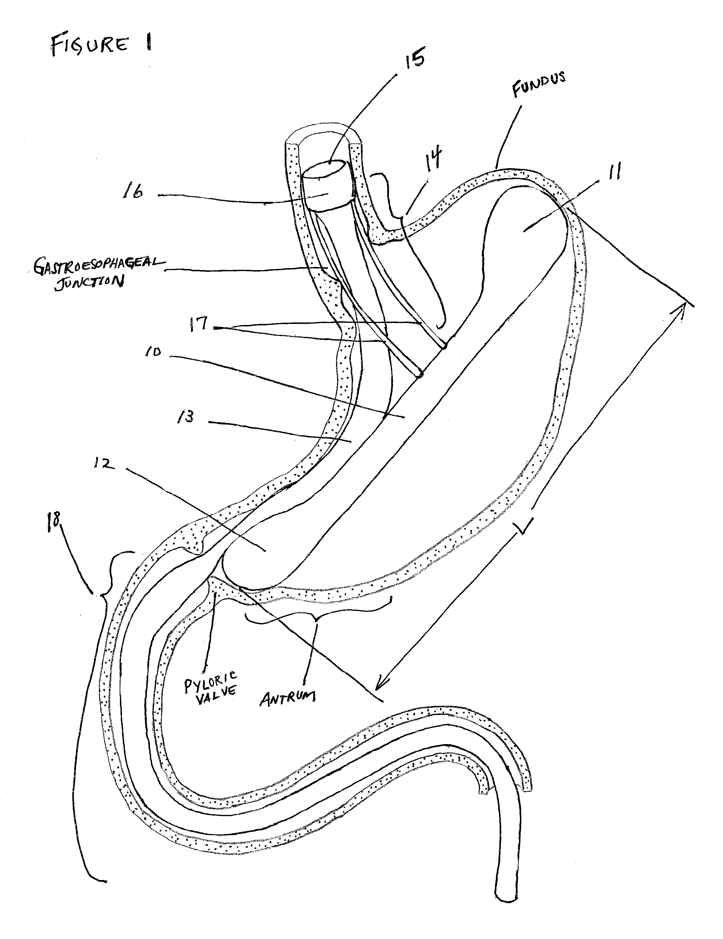 Intragastric Implant Devices