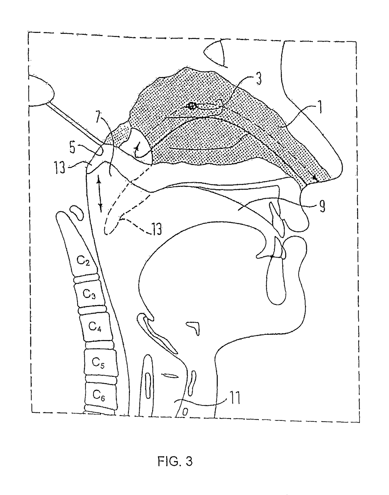 Nasal delivery