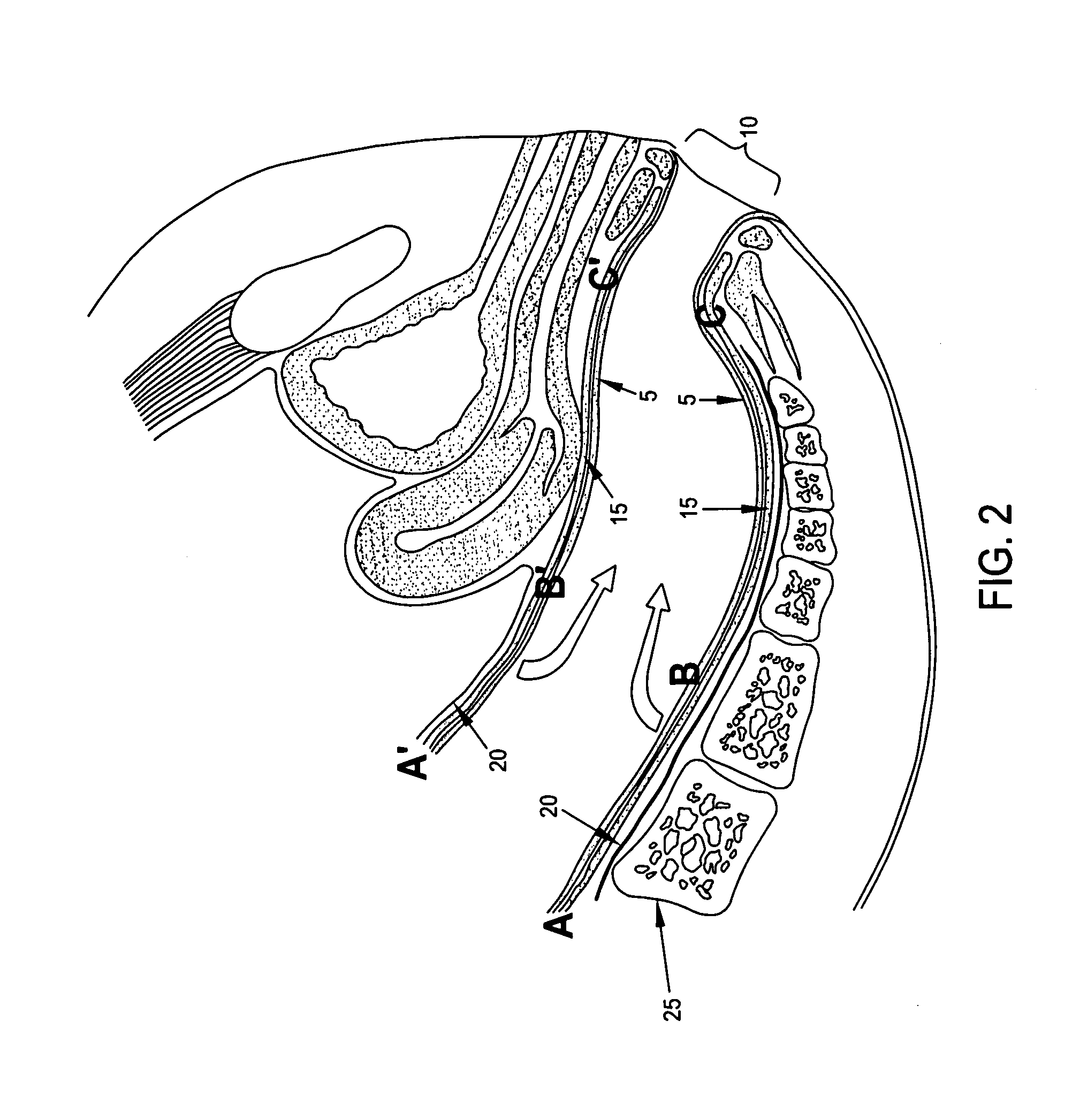 Method and apparatus for endoscopically treating rectal prolapse