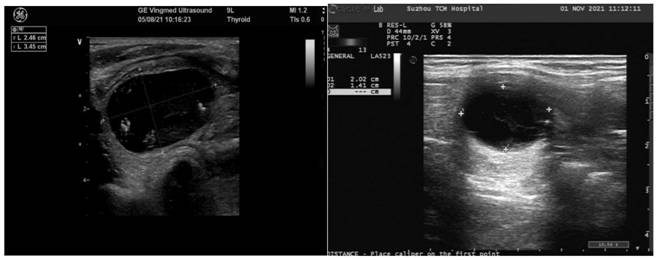 External traditional Chinese medicine composition for treating thyroid nodules and preparation method and application of external traditional Chinese medicine gel plaster