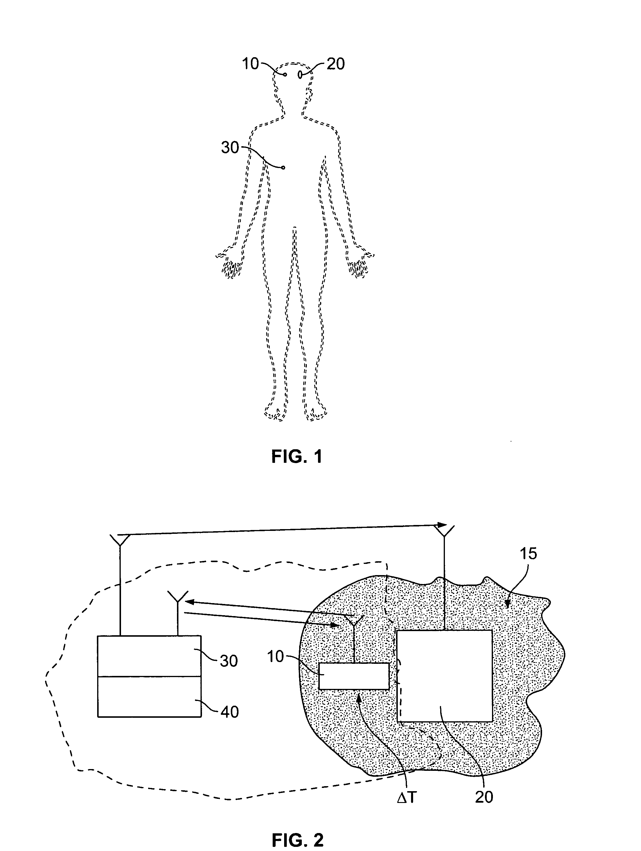 Surface acoustic wave probe implant for predicting epileptic seizures