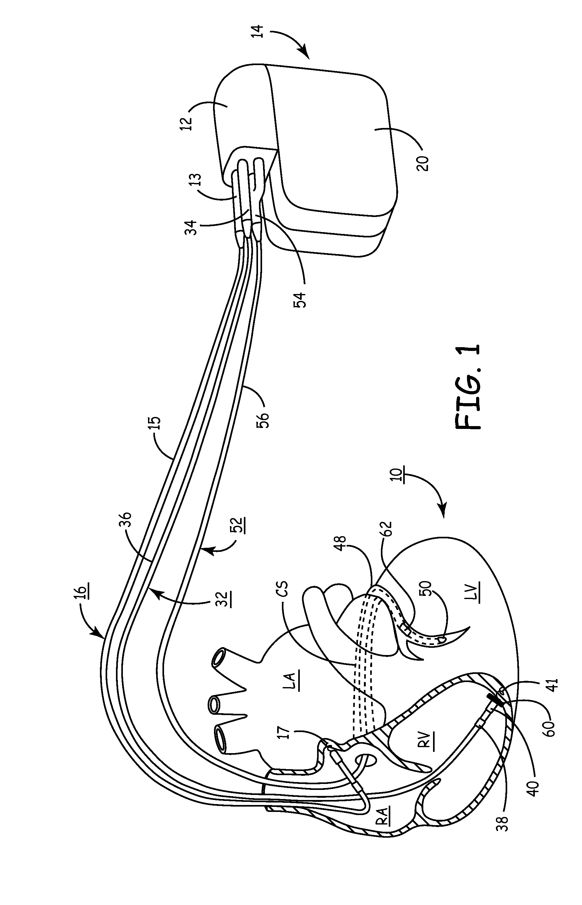 System and method for conditional biventricular pacing