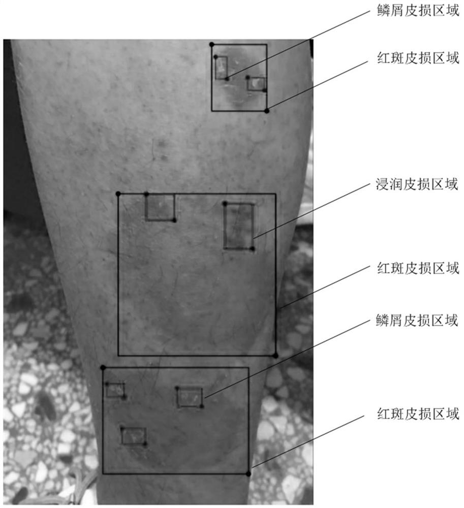 Image-based psoriasis severity assessment system