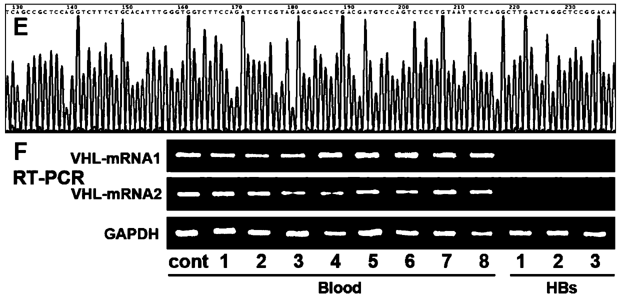 Medicine used for treating genetic imprinting subtype hemangioblastoma