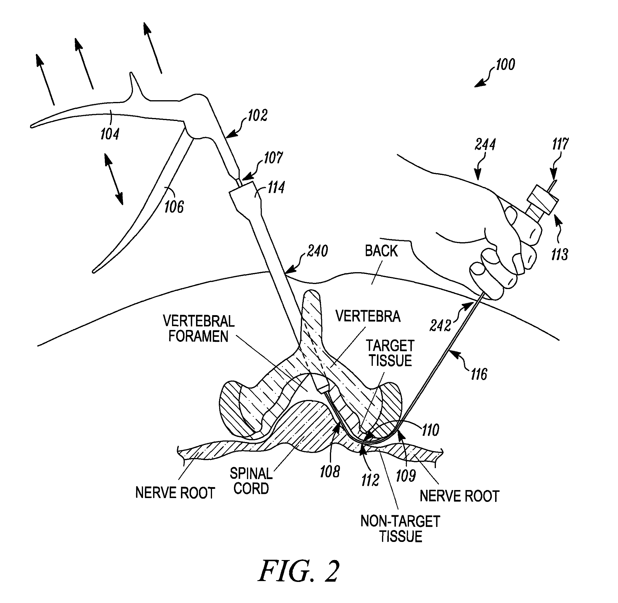 Spinal access and neural localization