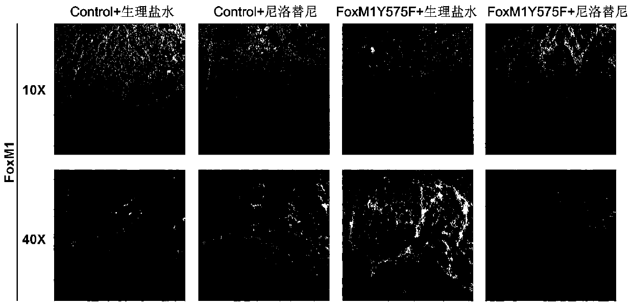 Application of c-Abl kinase inhibitor in FoxM1 high-expression tumor treatment