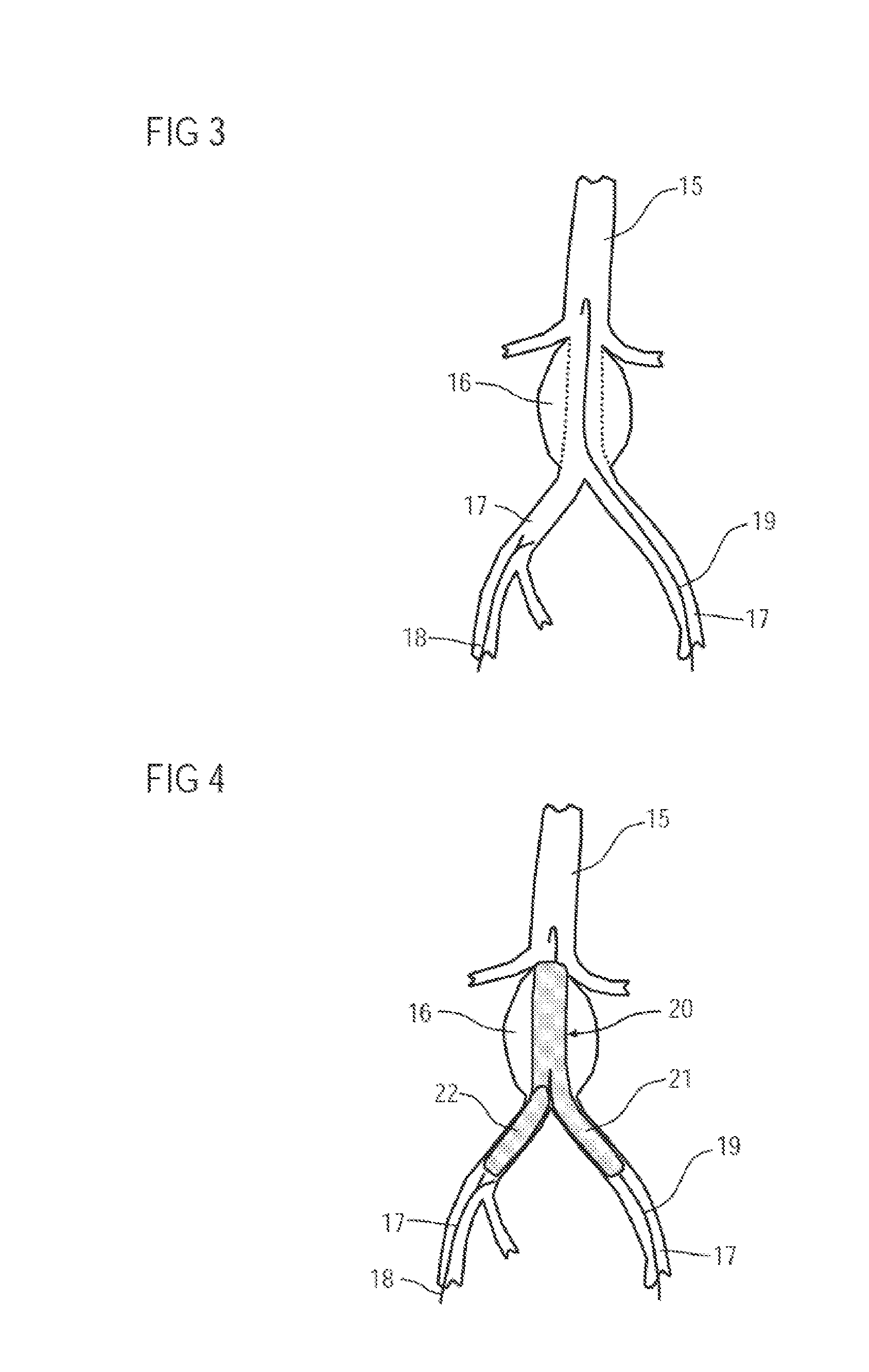 Angiographic Examination Method for a Vascular System