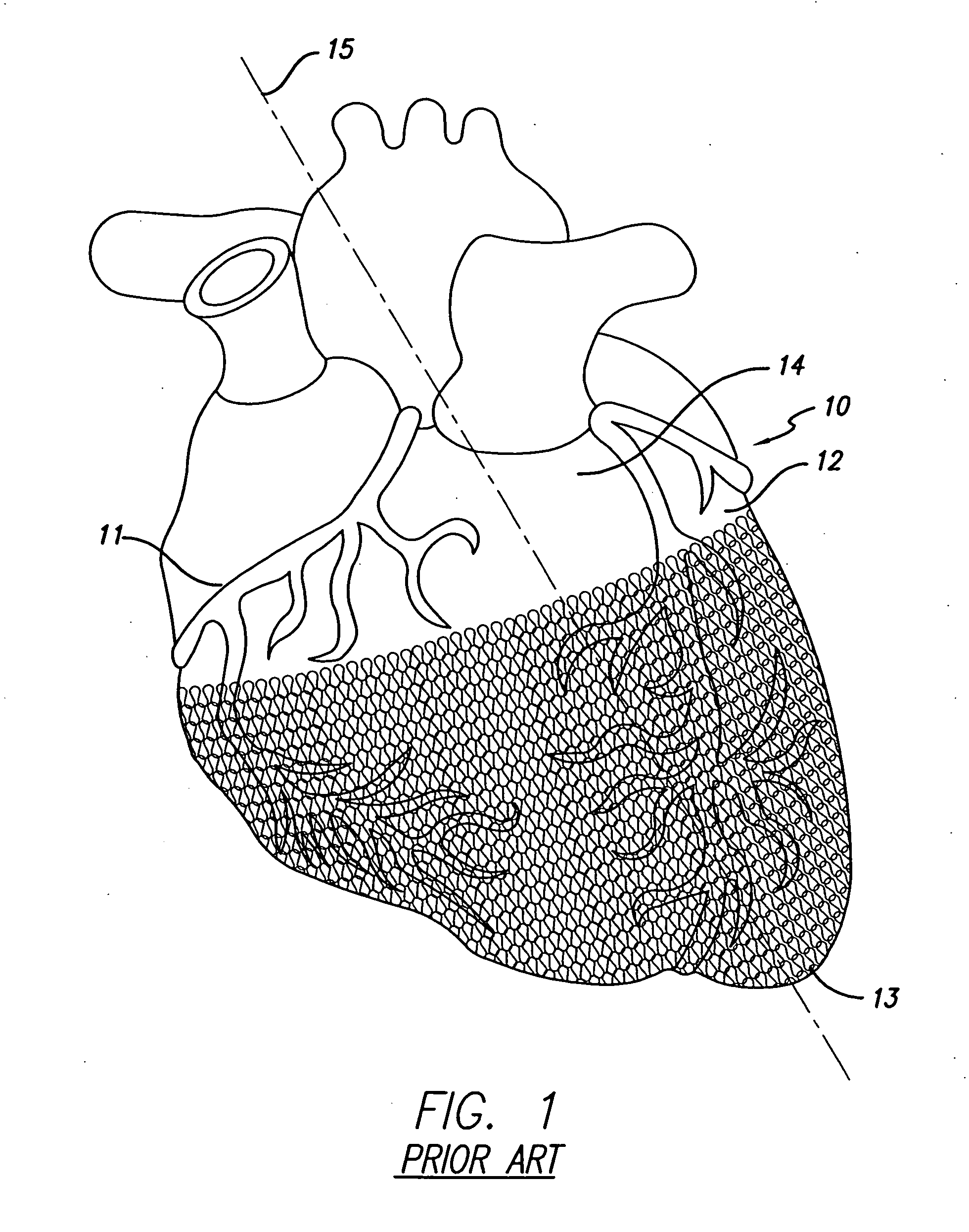 Cardiac harness having diagnostic sensors and method of use