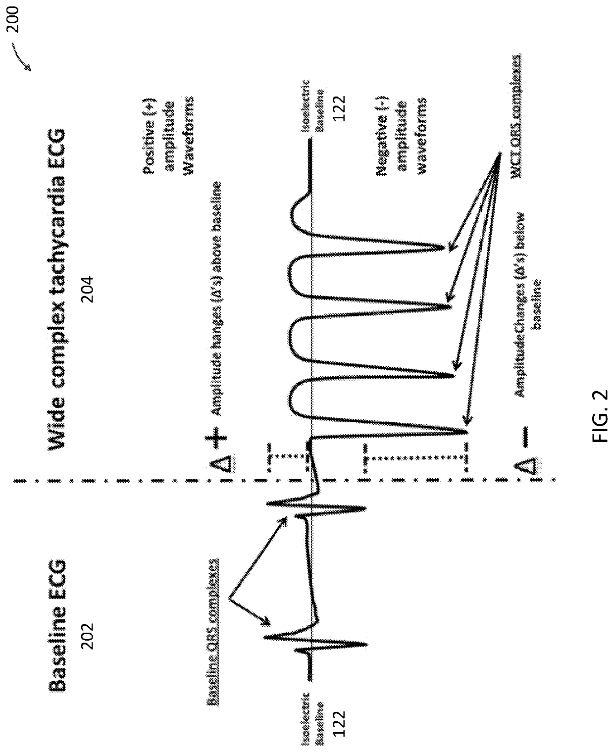 Apparatus and method for distinguishing wide complex heart beats