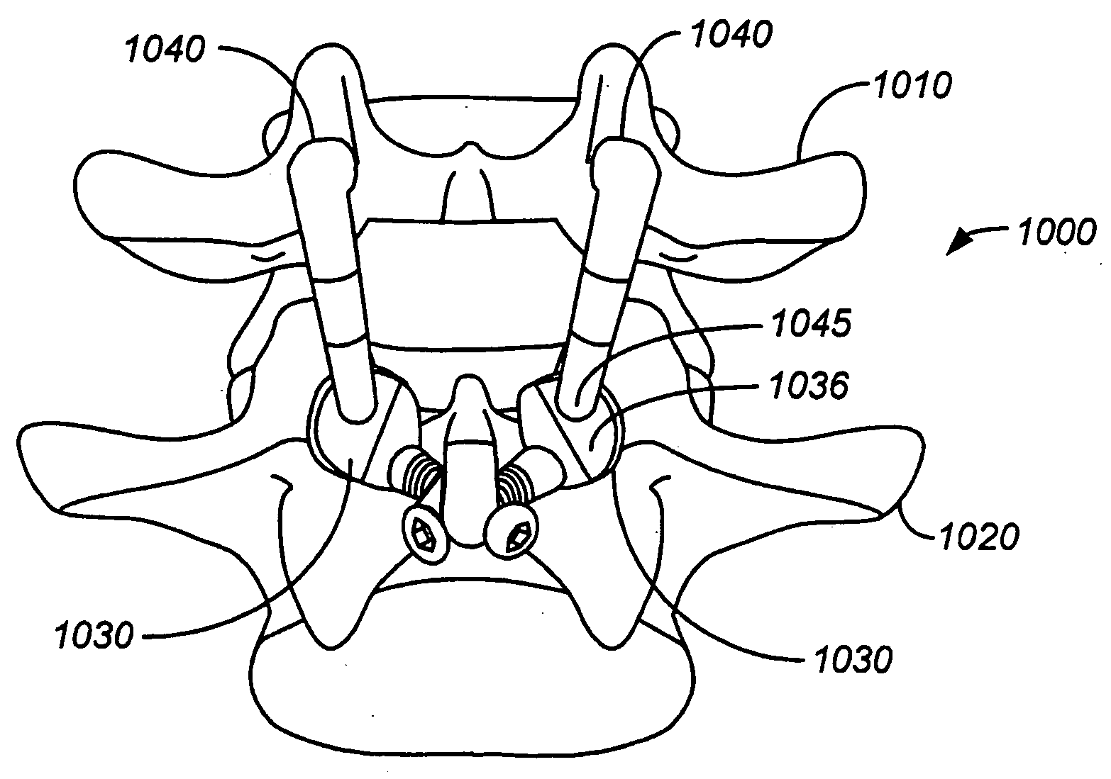 Prostheses, tools and methods for replacement of natural facet joints with artifical facet joint surfaces