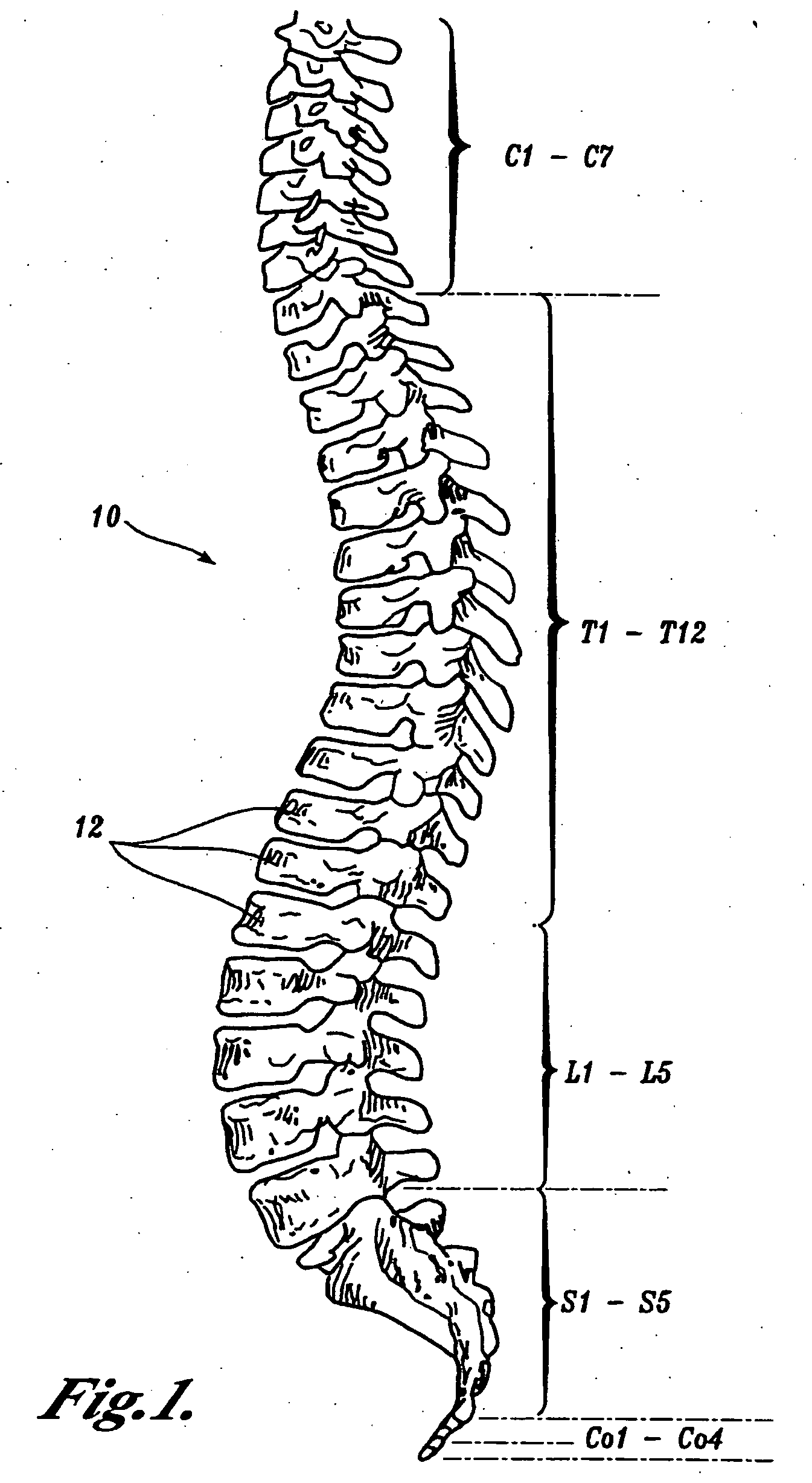 Prostheses, tools and methods for replacement of natural facet joints with artifical facet joint surfaces