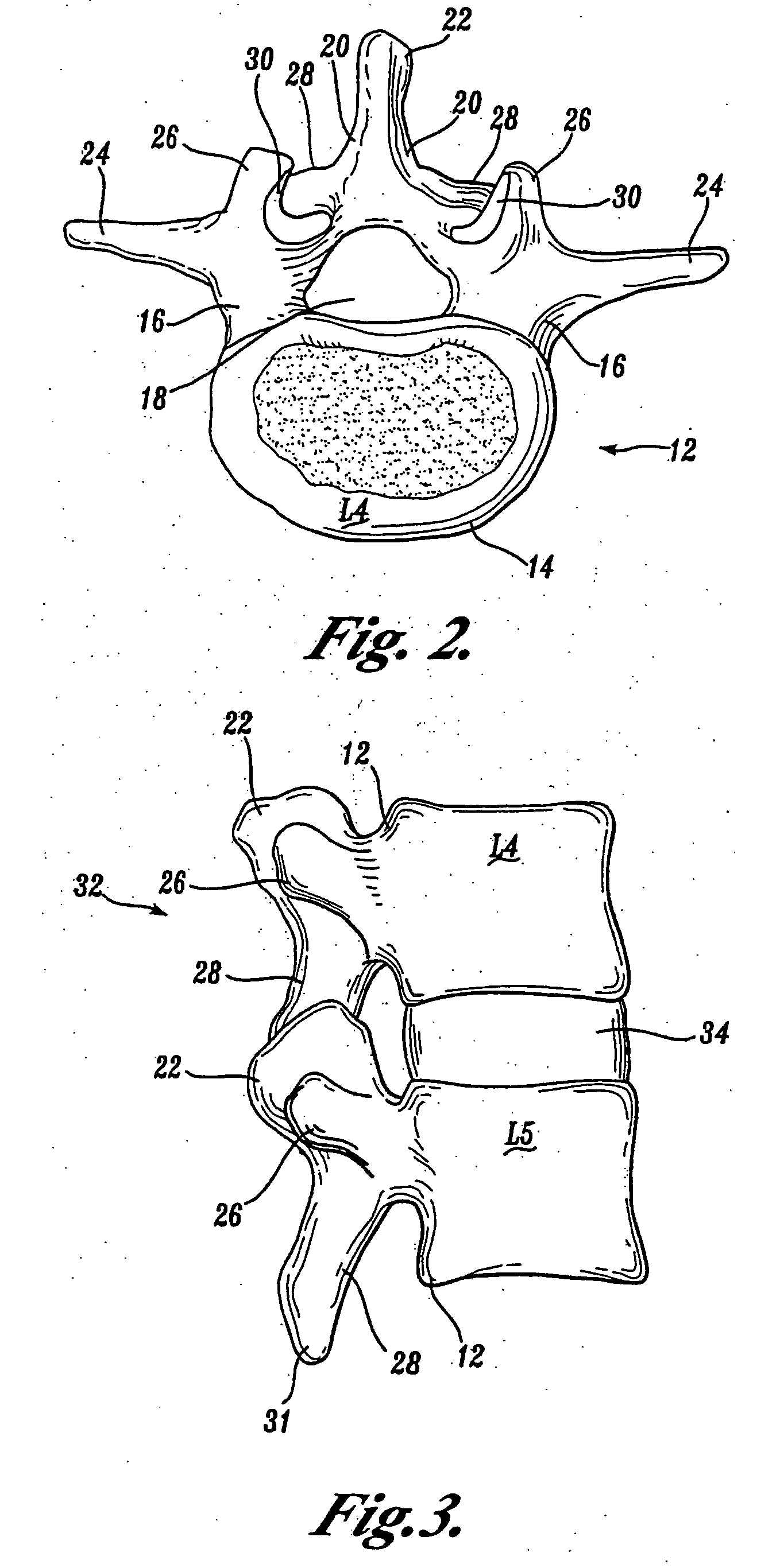 Prostheses, tools and methods for replacement of natural facet joints with artifical facet joint surfaces