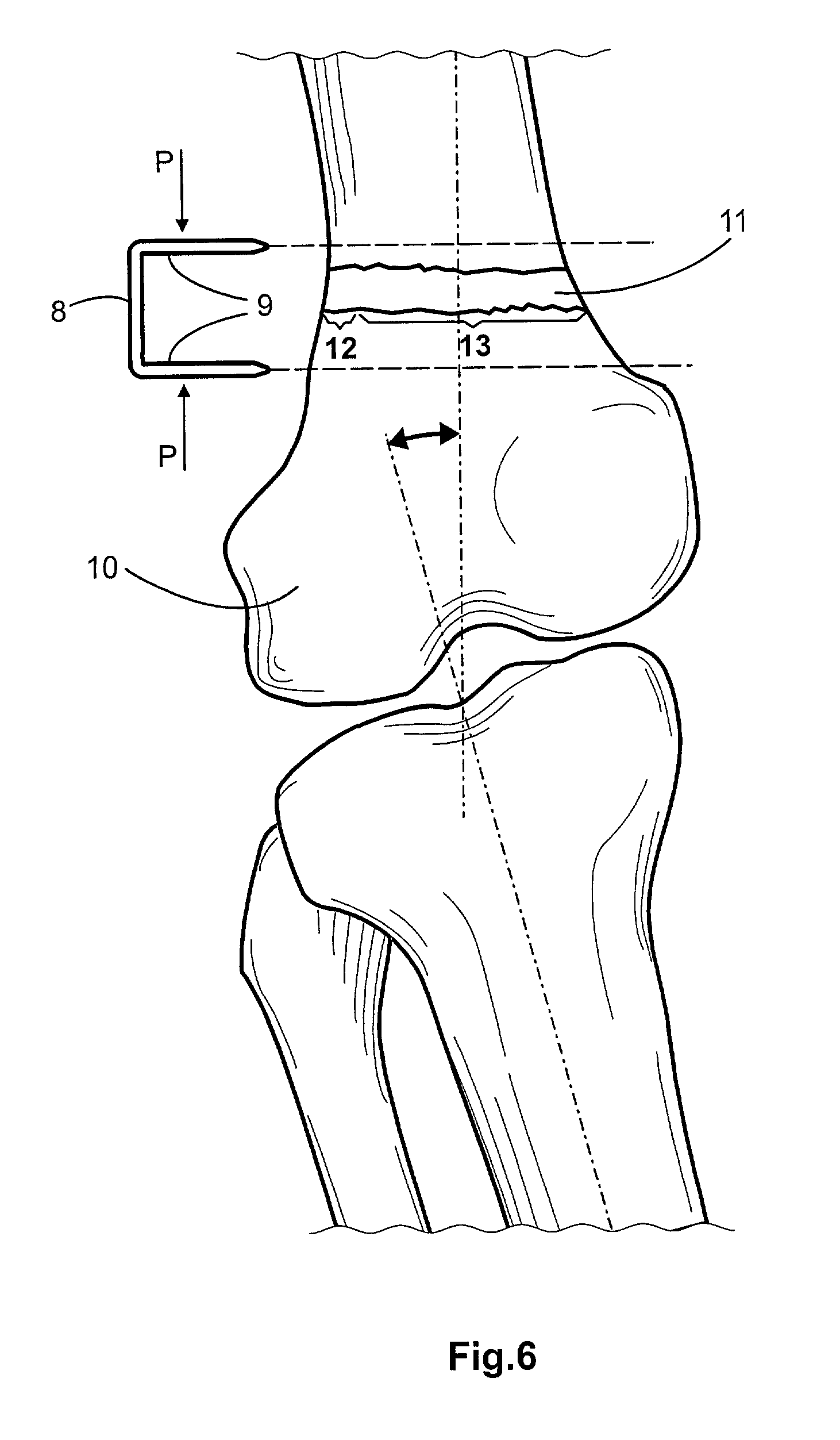 Bone staple and methods for correcting bone deficiencies by controllably suppressing and/or inducing the growth of the epiphyseal plate