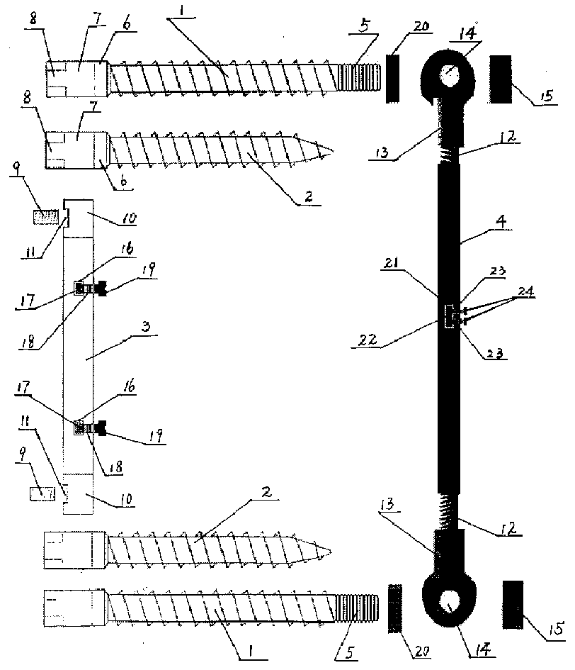 Front thoracolumbar fixing system via pedicle of vertebral arch