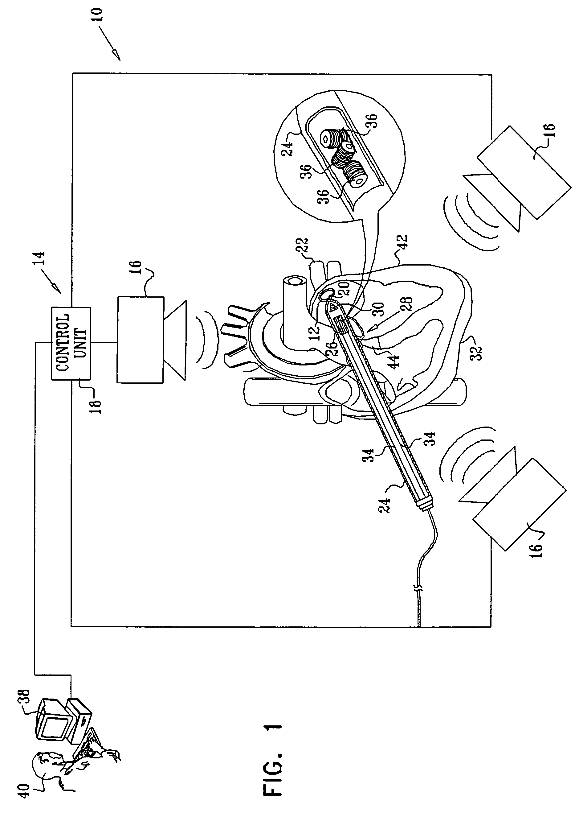 Externally applied RF for pulmonary vein isolation